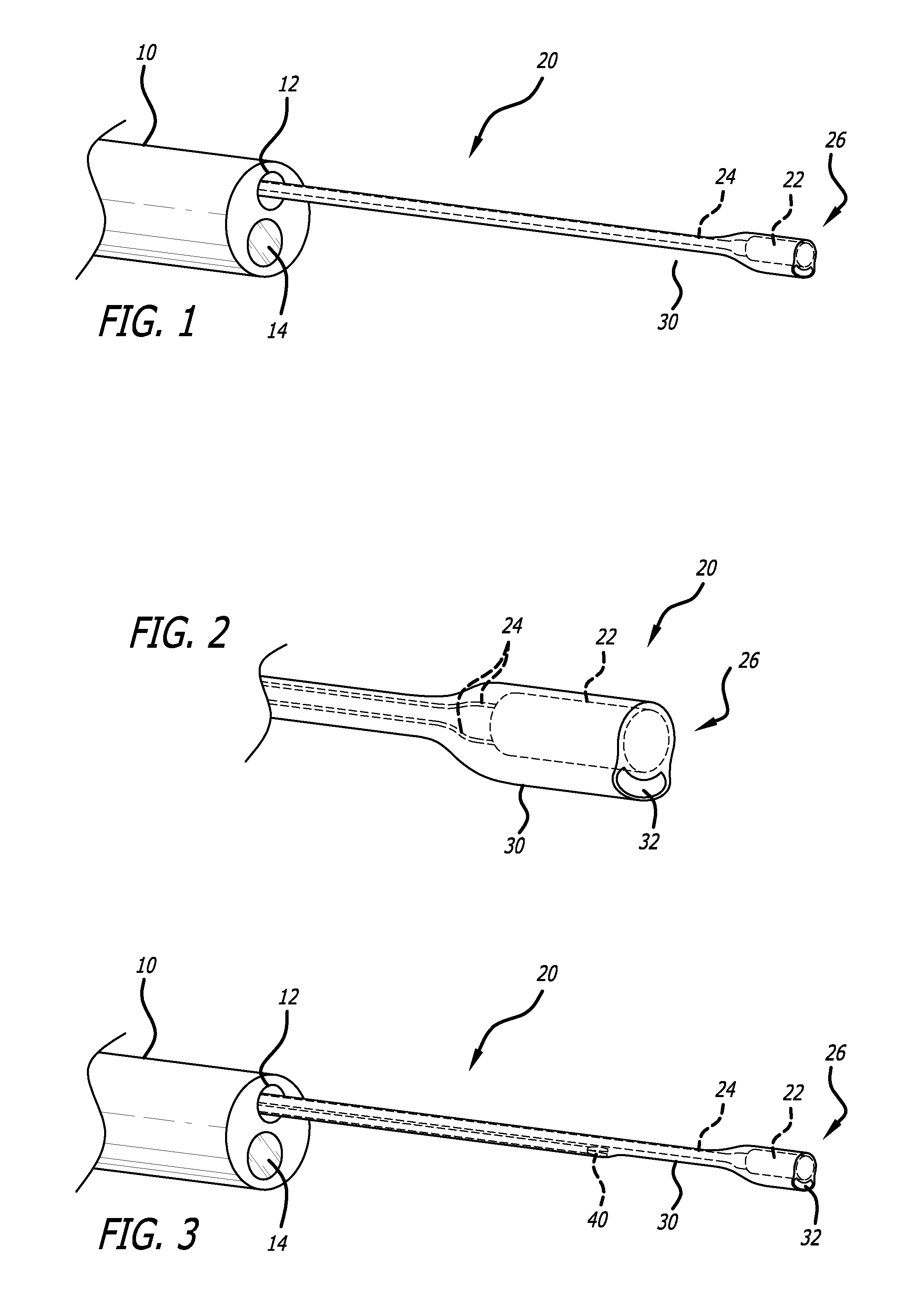 Locatable Expandable Working Channel And Method