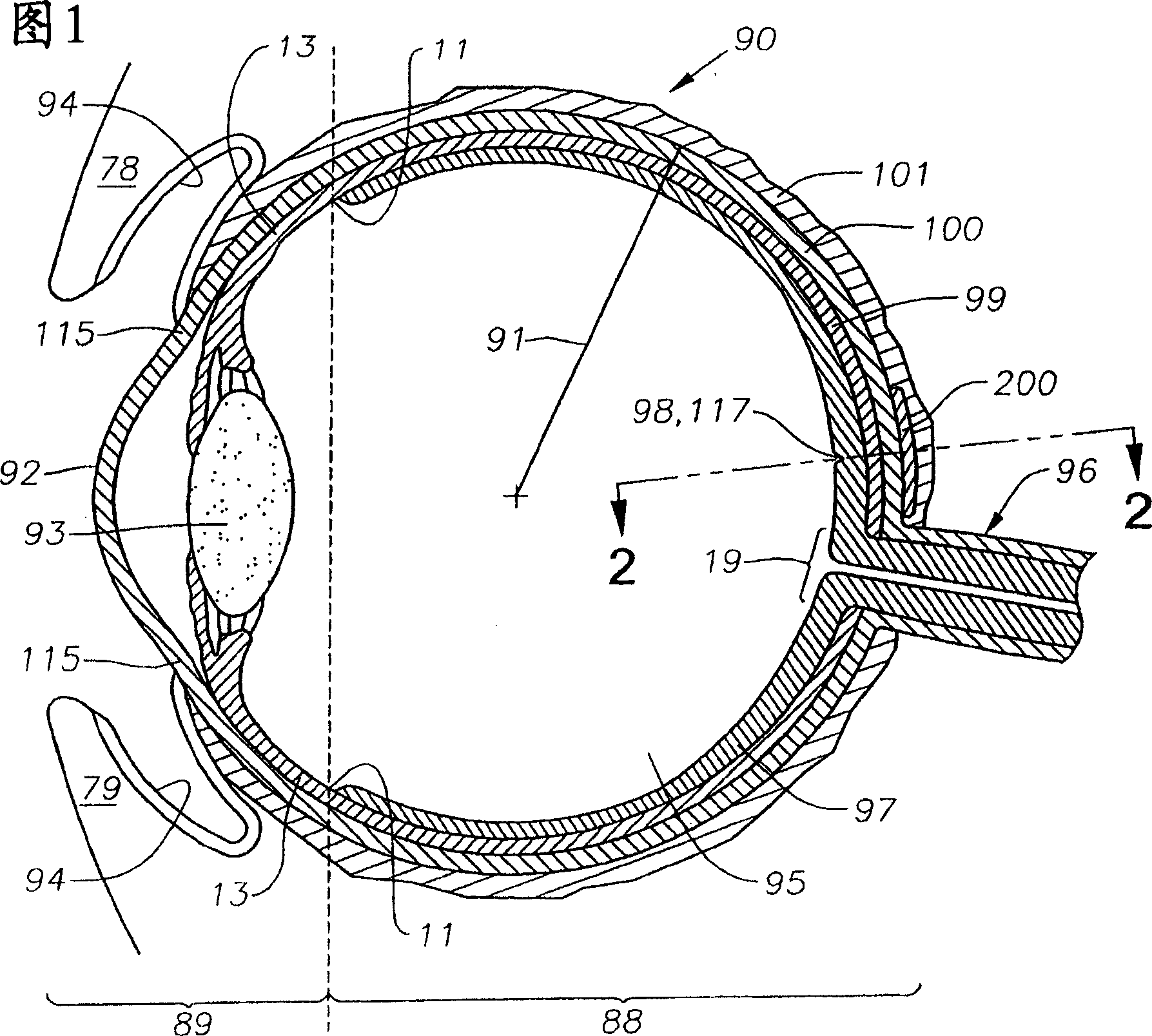 Ophthalmic drug delivery device