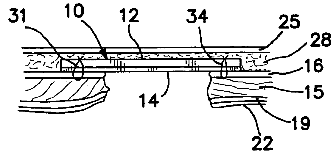 Surgical prosthesis having biodegradable and nonbiodegradable regions