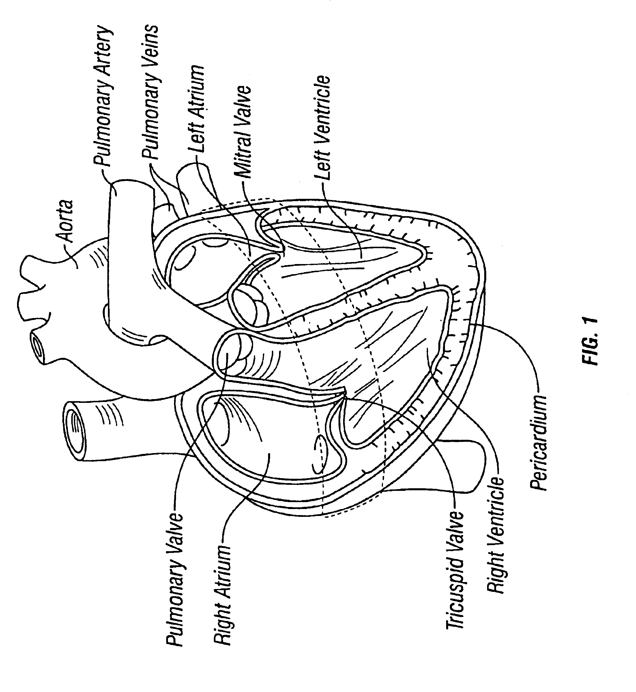 Method and apparatus for external stabilization of the heart
