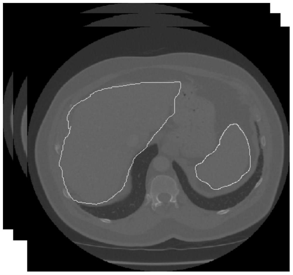 Fatty liver intelligent grading evaluation method based on abdominal CT