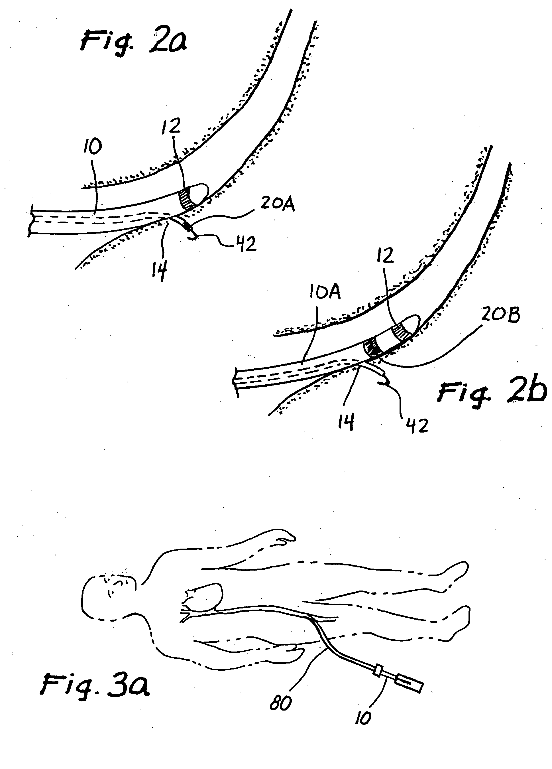 Devices and methods for transluminal or transthoracic interstitial electrode placement