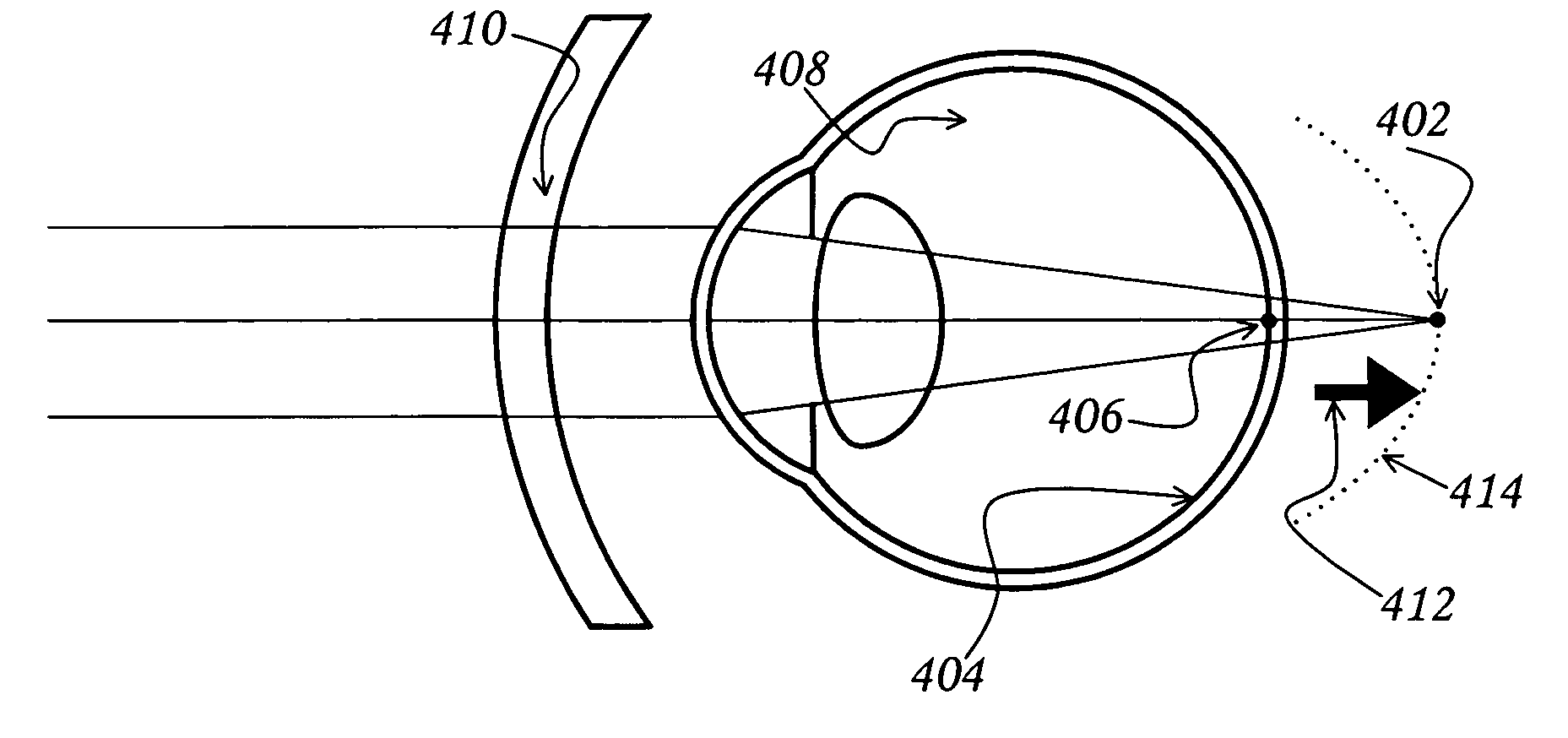 Methods and apparatuses for altering relative curvature of field and positions of peripheral, off-axis focal positions