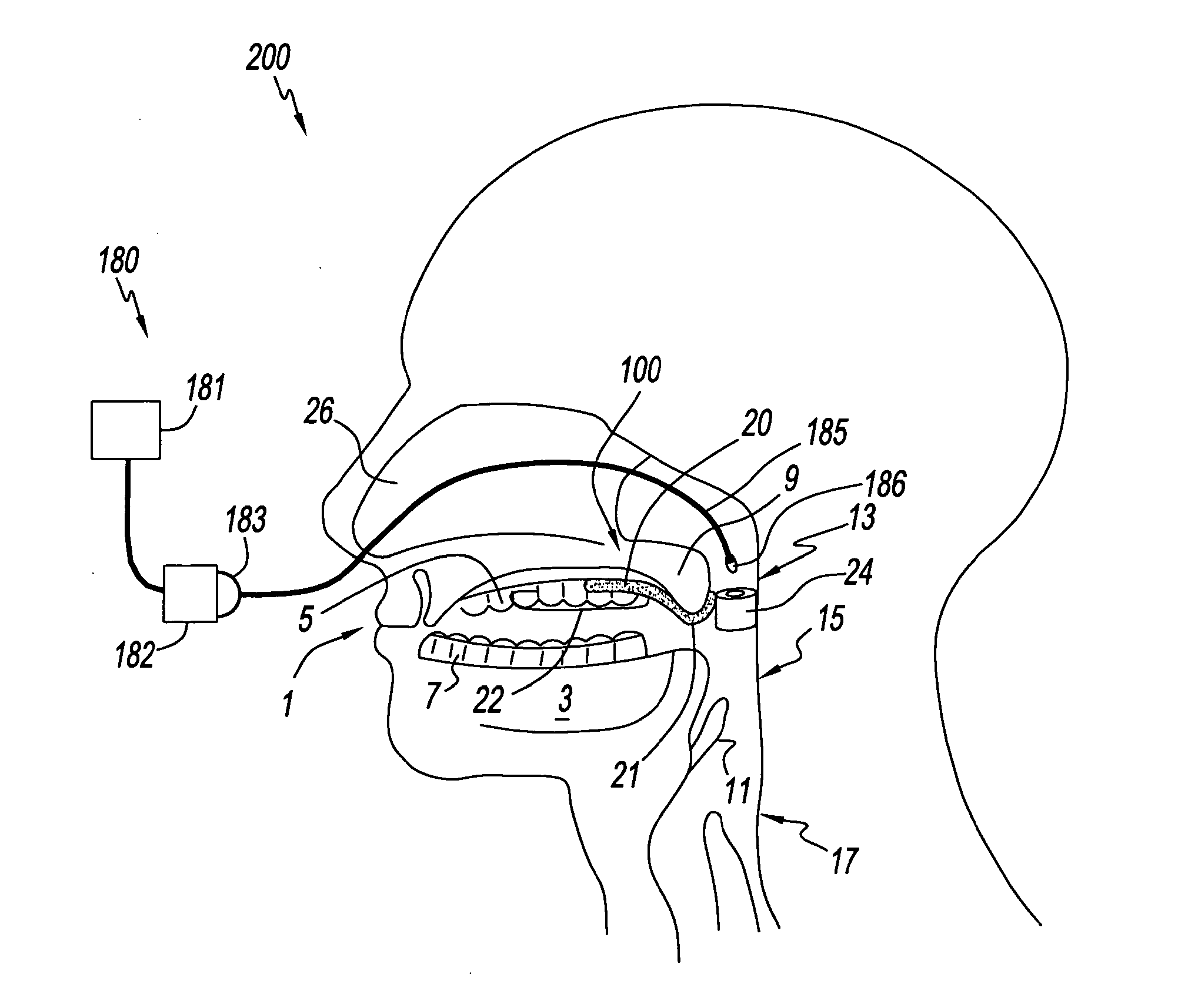 A palate retainer with attached nasopharyngeal airway extender for use in the treatment of obstructive sleep apnea