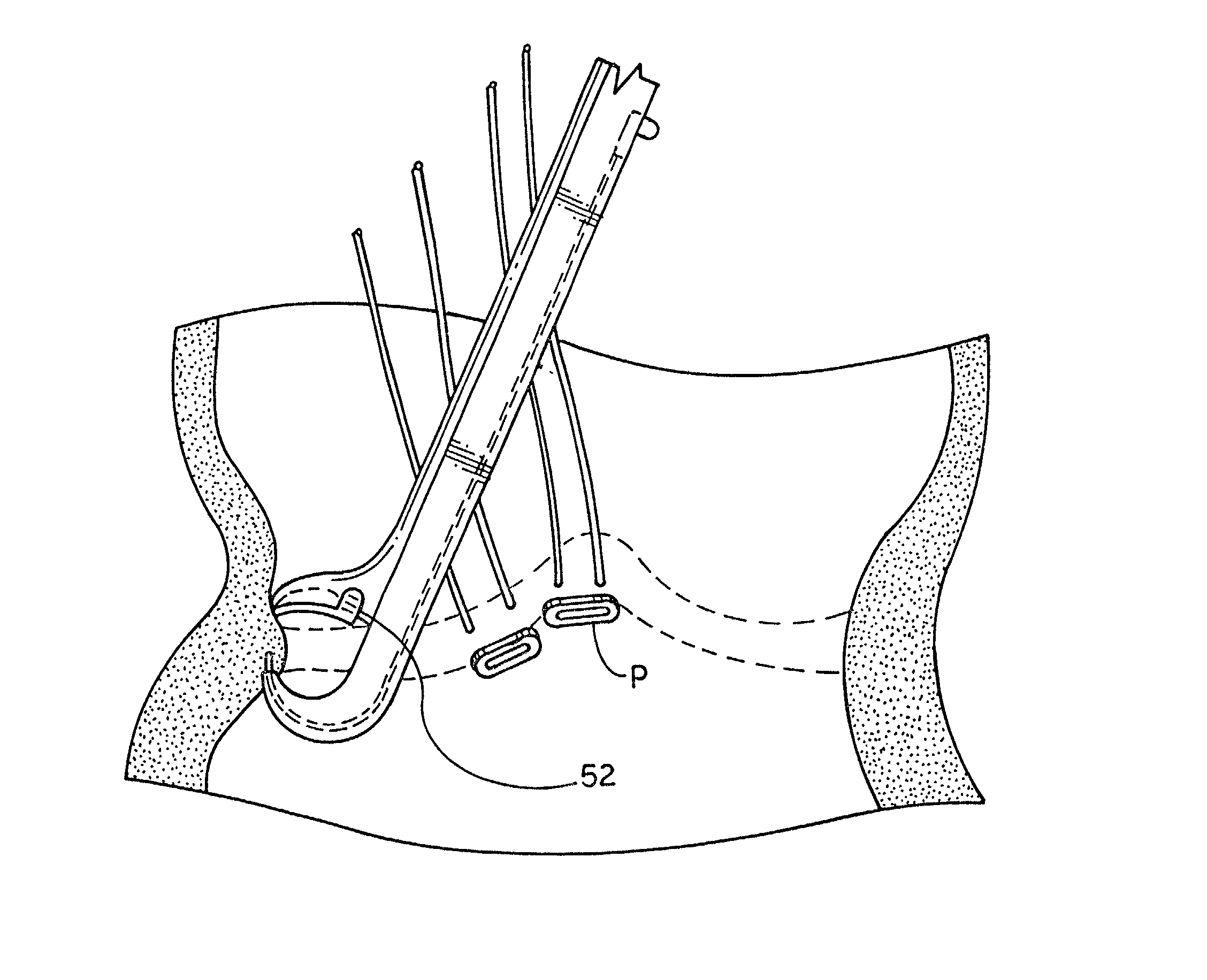 Extremely long wire fasteners for use in minimally invasive surgery and means and method for handling those fasteners