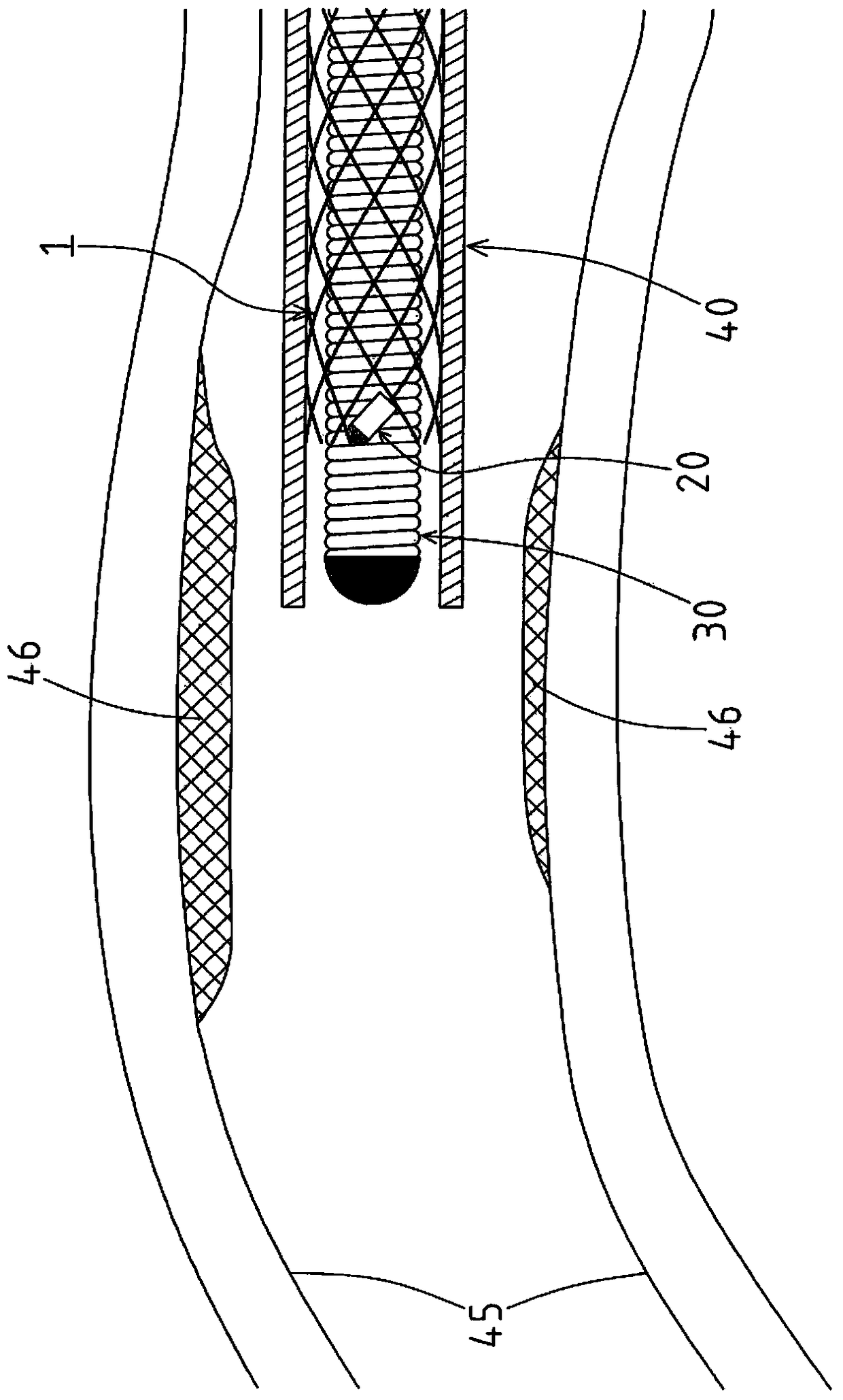 self-expanding stent