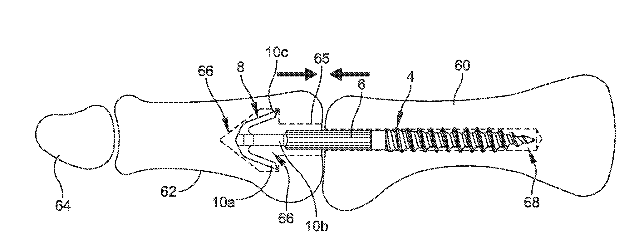 Hammertoe implant and instrument