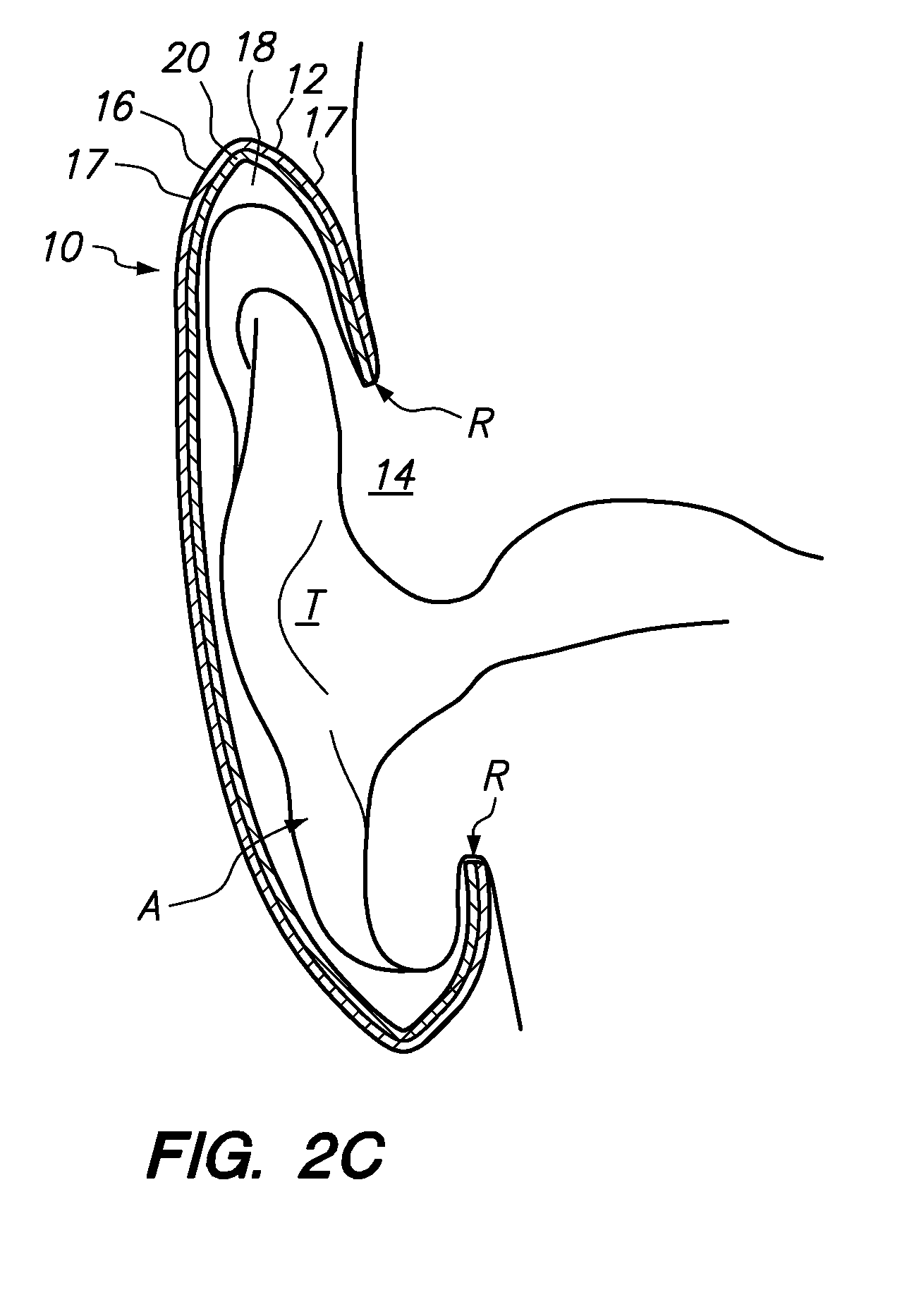 Methods and apparatus for ear protection