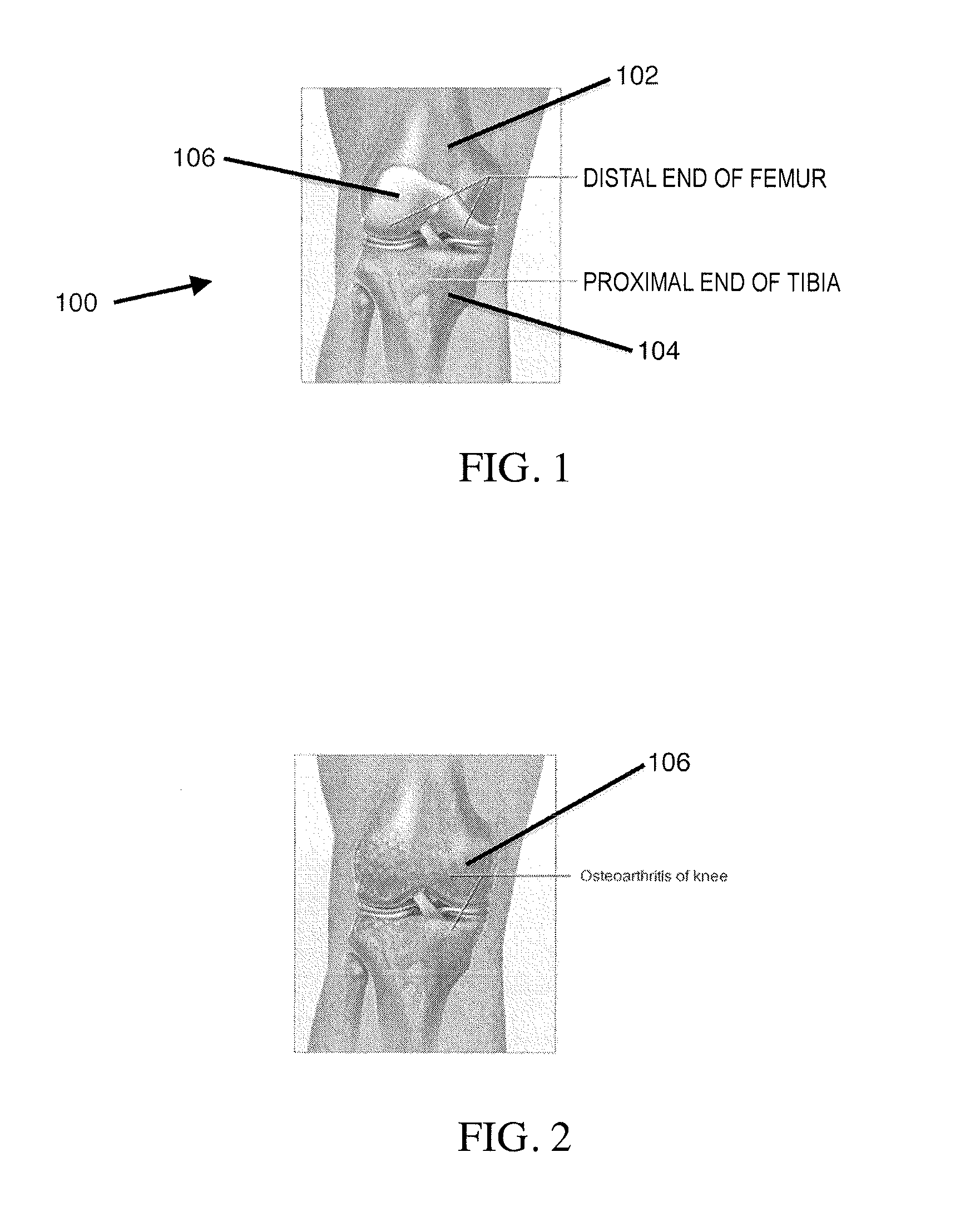 Systems and methods for providing alignment in total knee arthroplasty