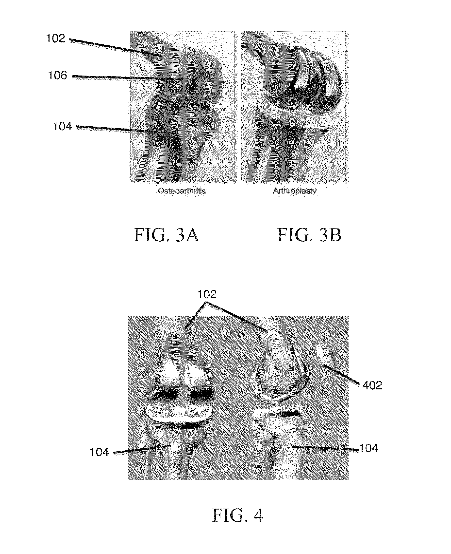 Systems and methods for providing alignment in total knee arthroplasty