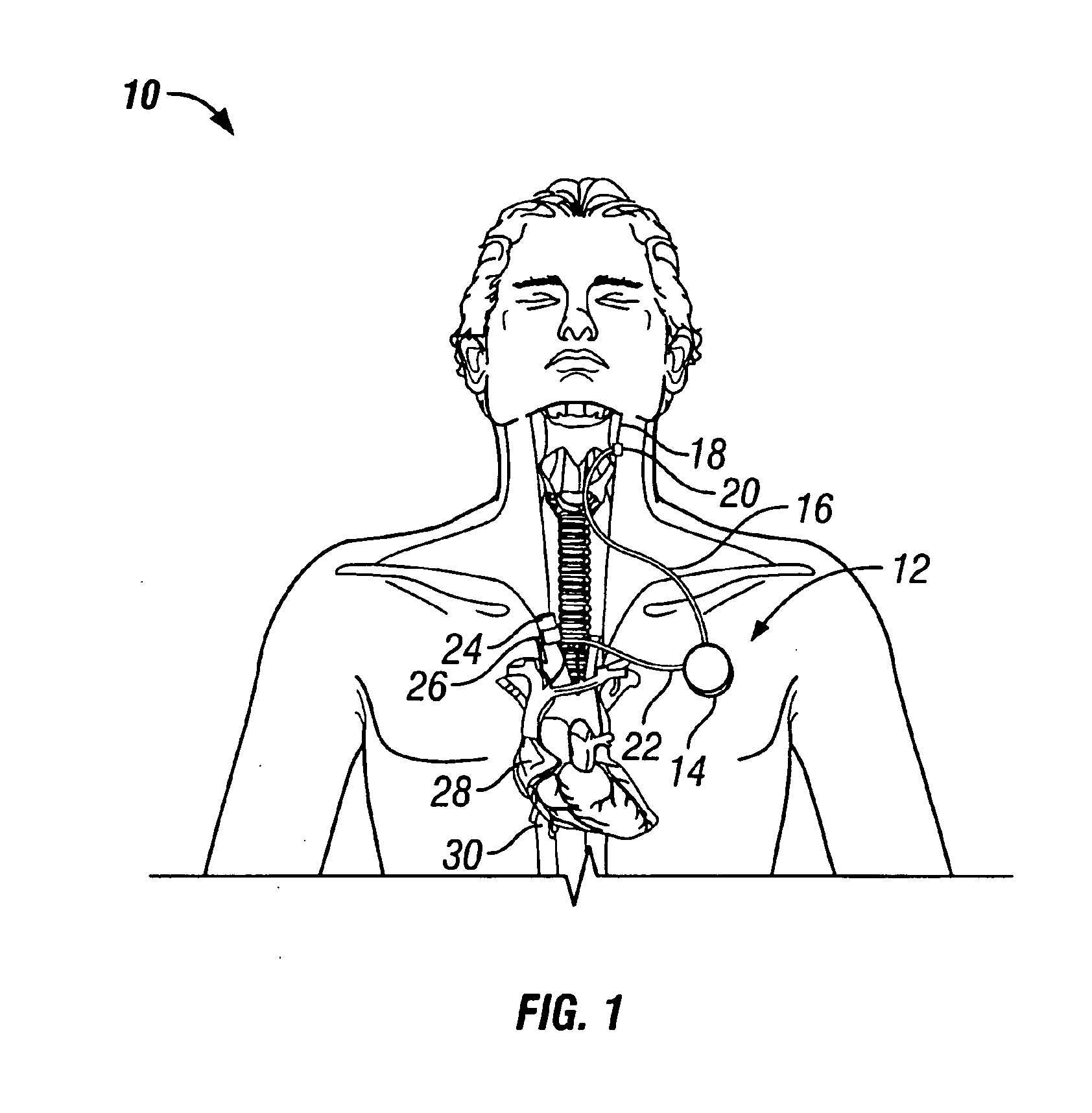 Apparatus and methods for cooling a region within the body