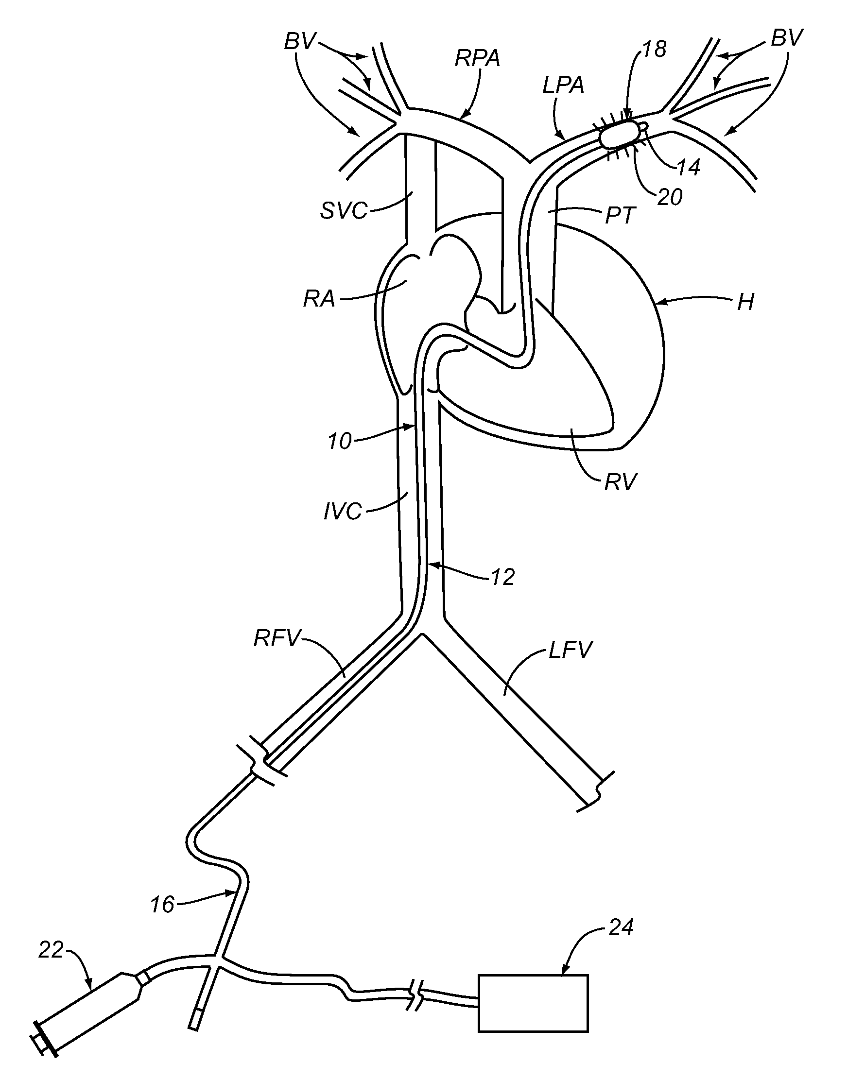 Apparatus and methods for treating pulmonary hypertension
