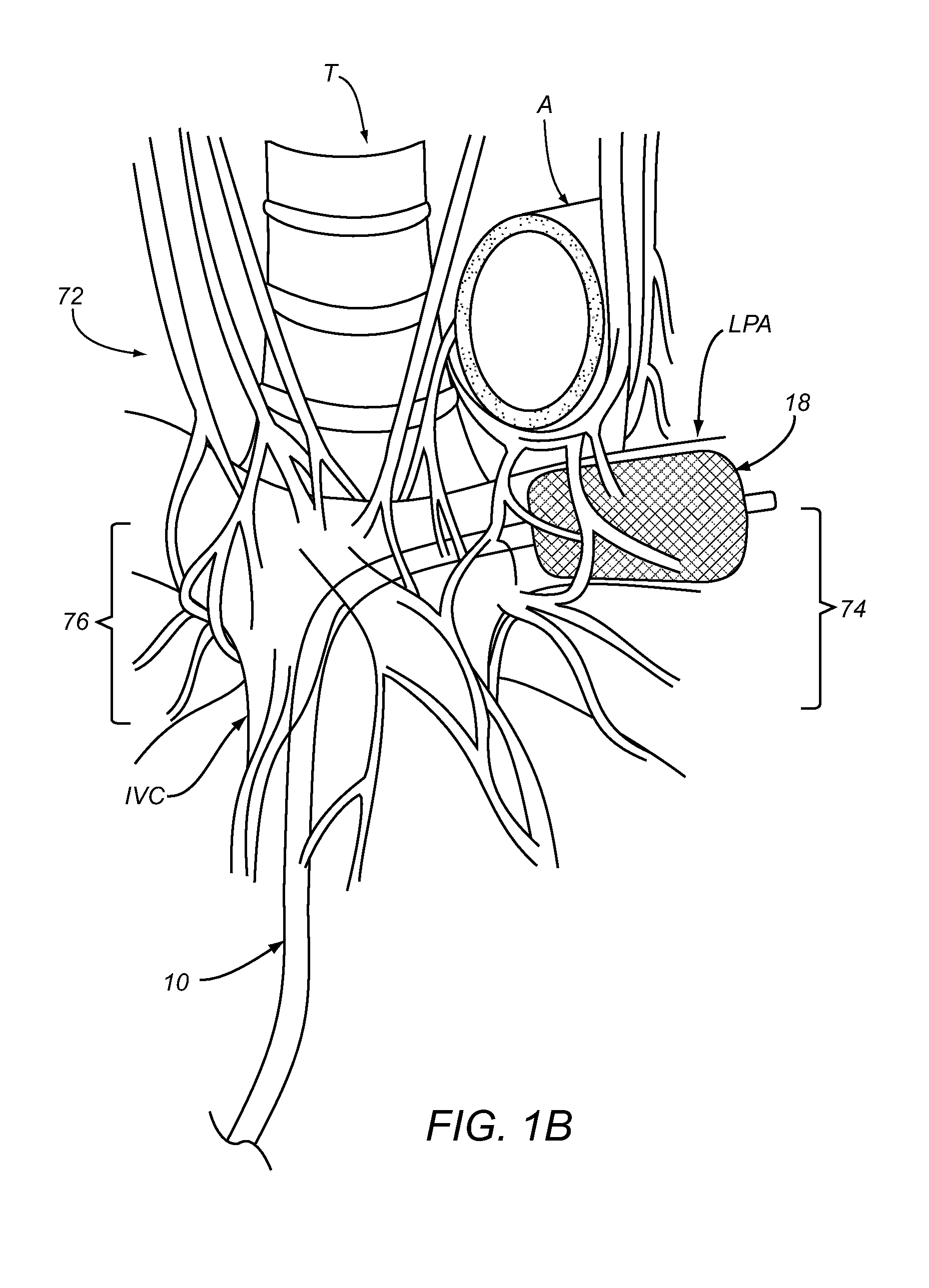 Apparatus and methods for treating pulmonary hypertension