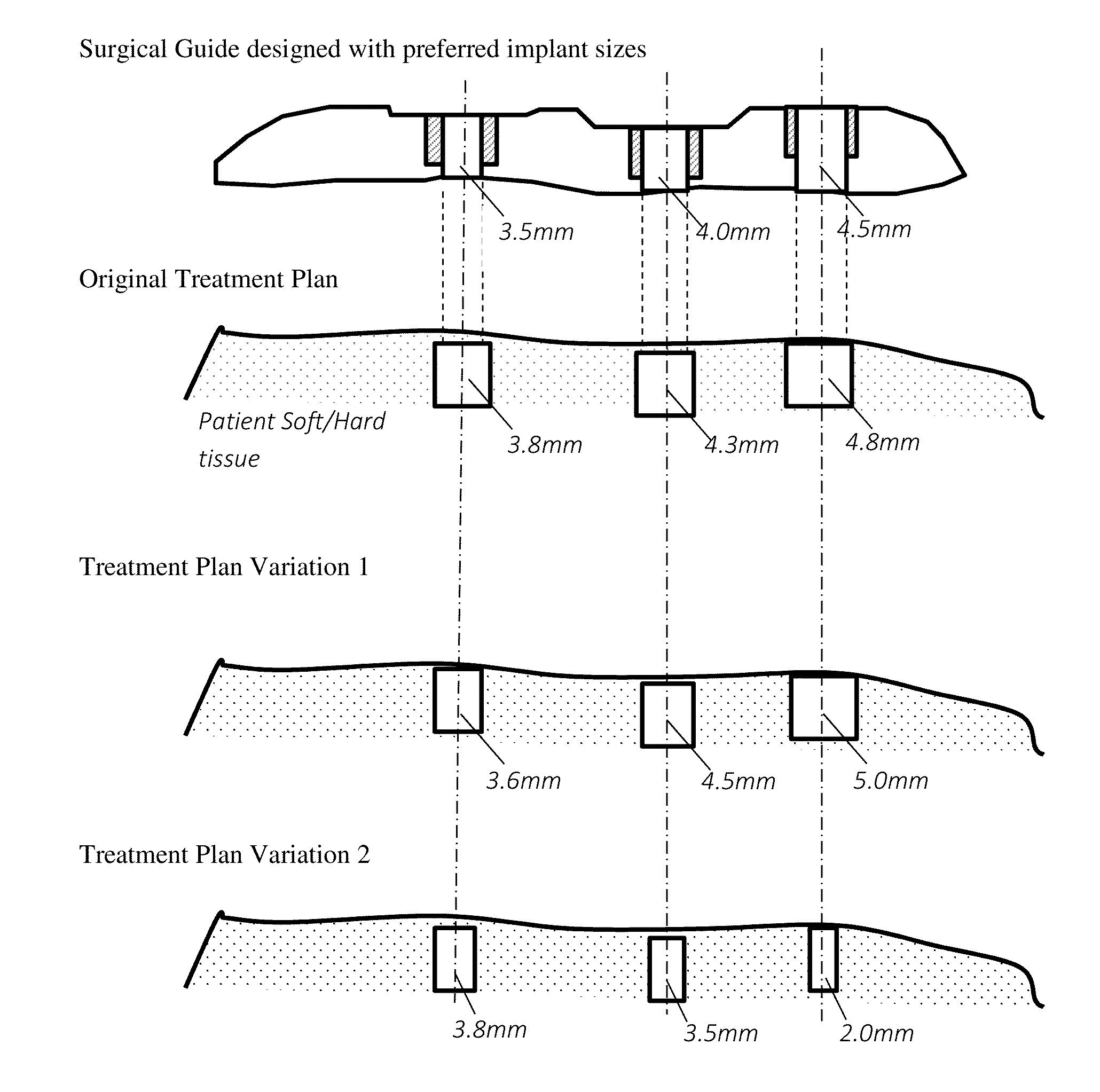 Method and system for dental implant surgical guides