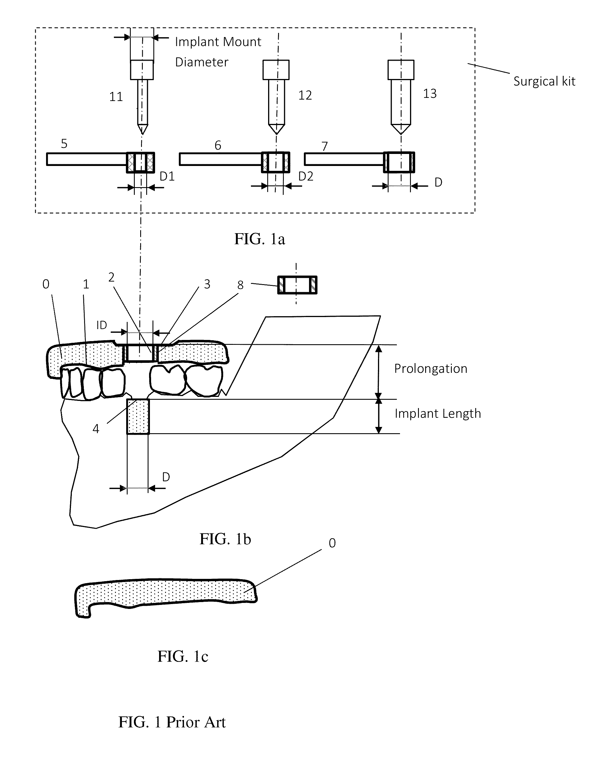 Method and system for dental implant surgical guides