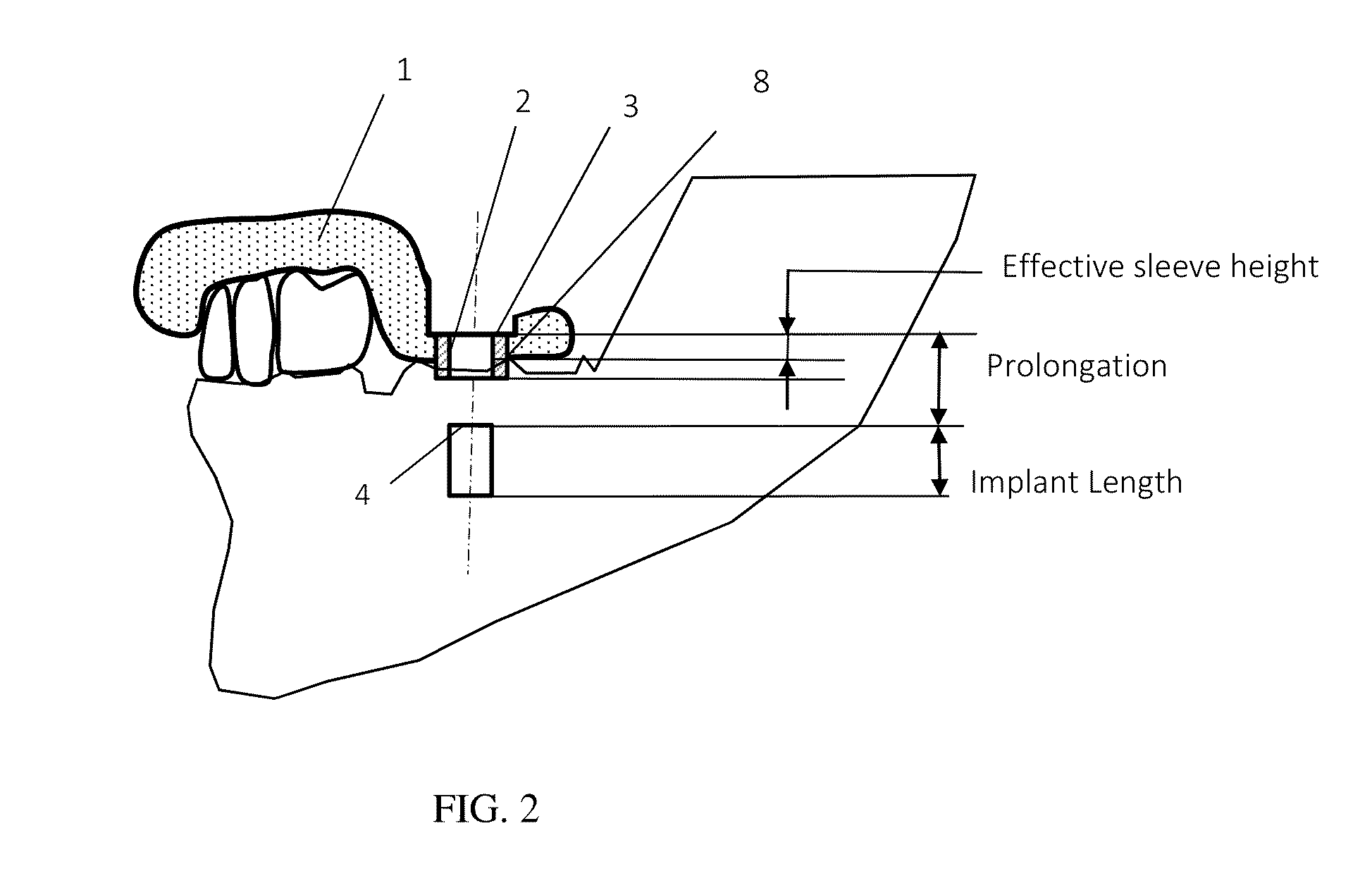 Method and system for dental implant surgical guides