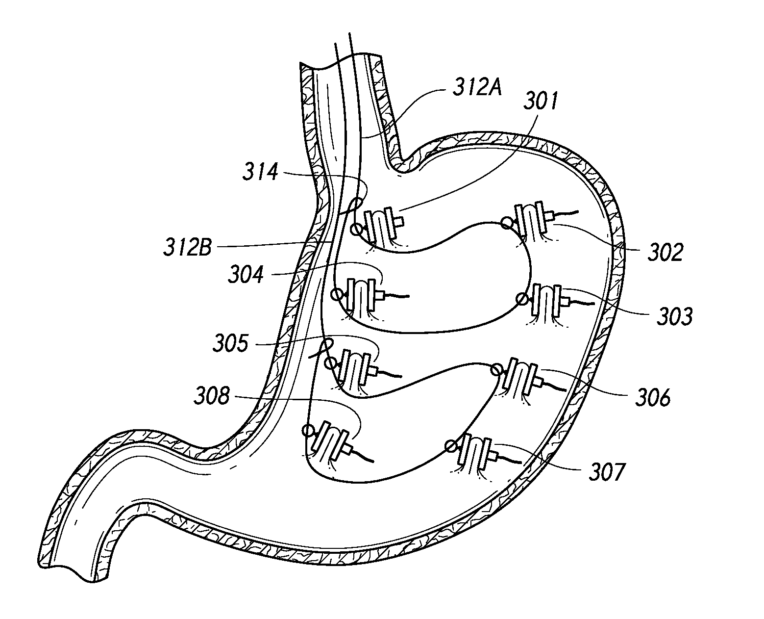 Devices and methods for the endolumenal treatment of obesity