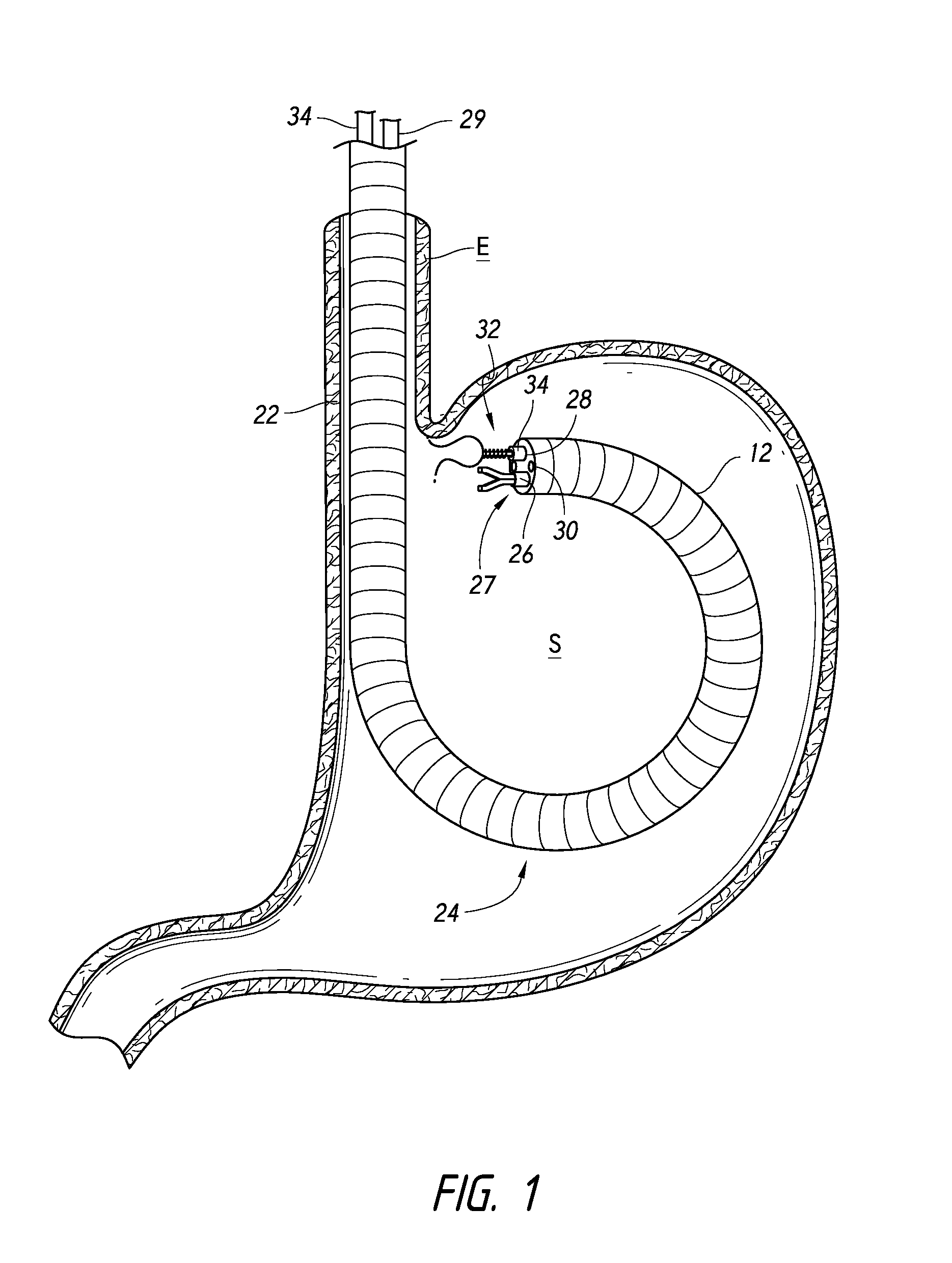 Devices and methods for the endolumenal treatment of obesity