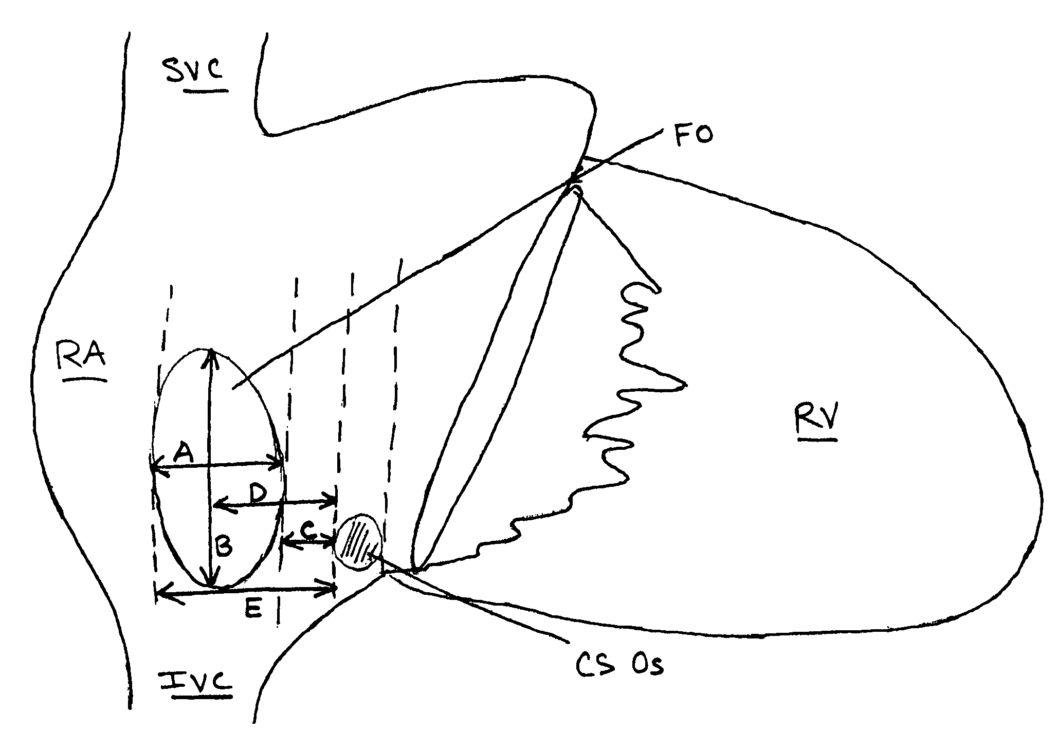 Method and apparatus for locating the fossa ovalis, creating a virtual fossa ovalis and performing transseptal puncture