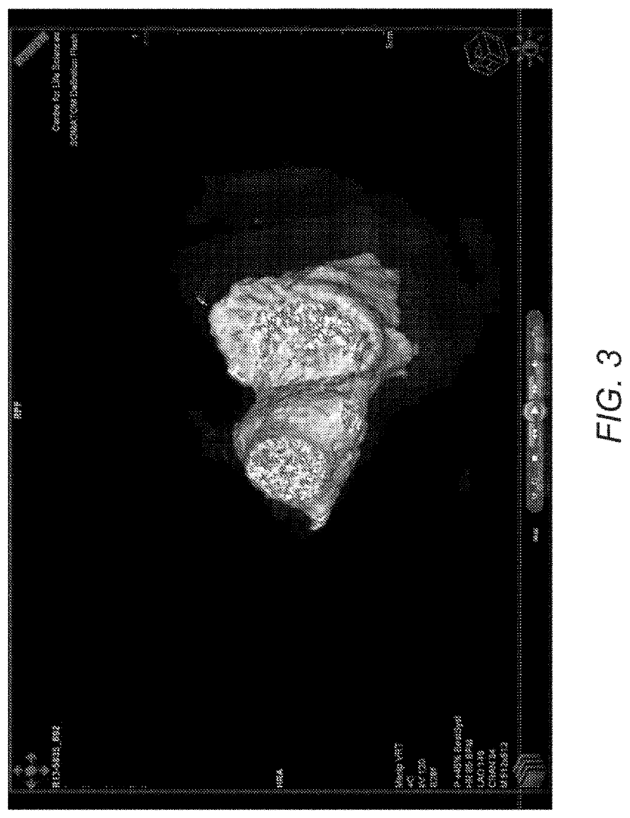 Naturally designed mitral prosthesis