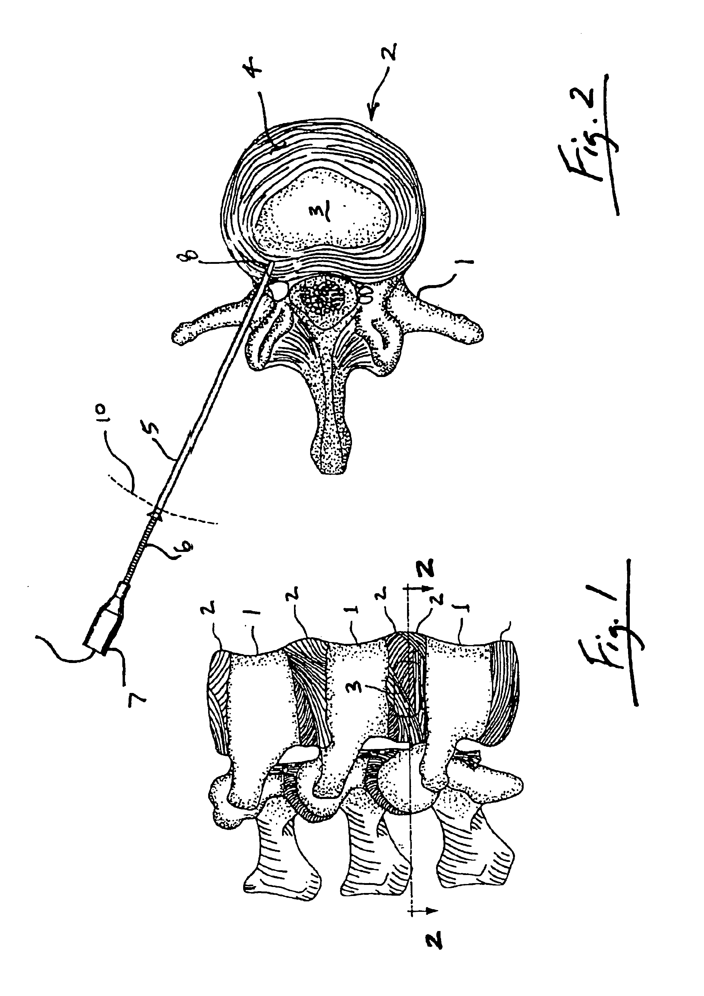 Intradiscal lesioning device