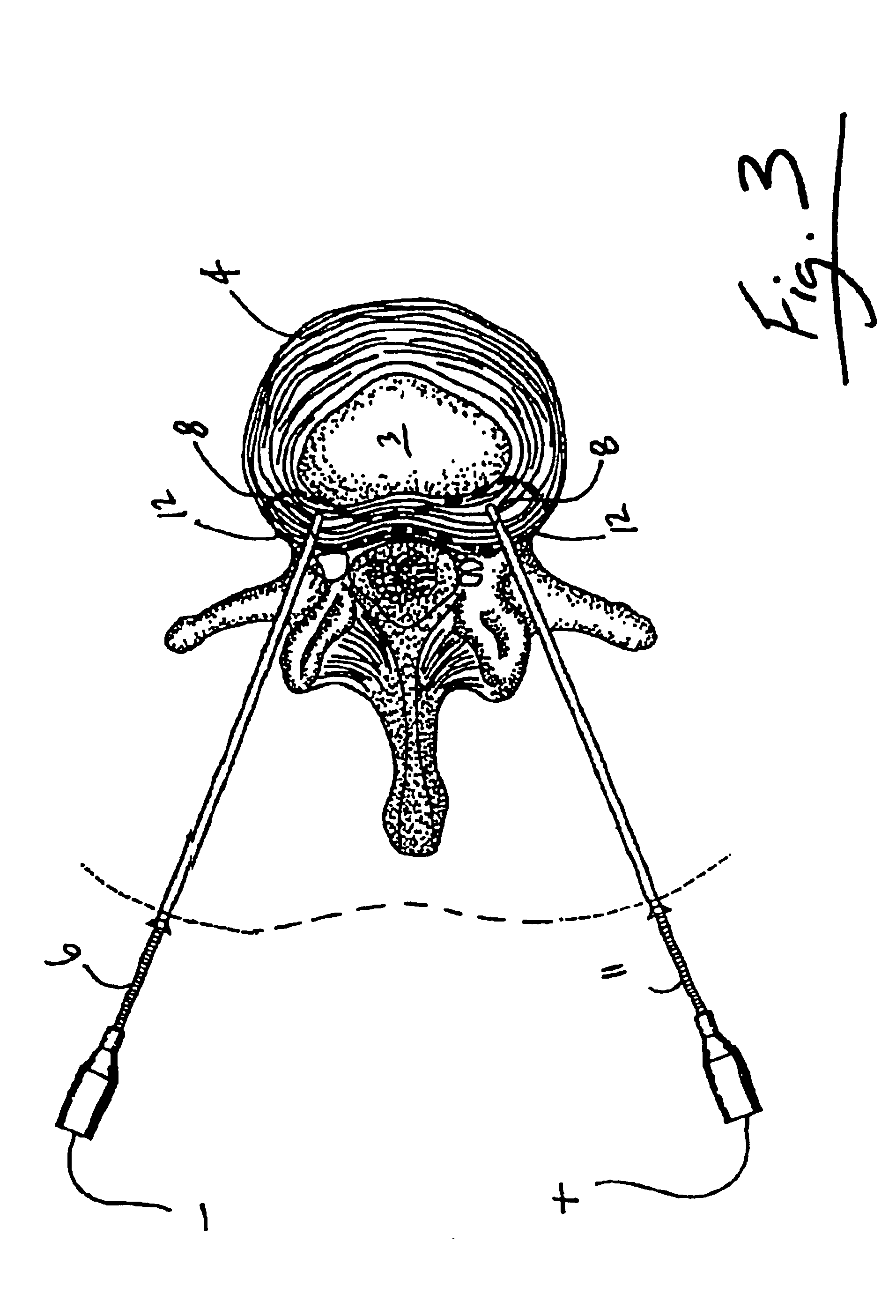 Intradiscal lesioning device