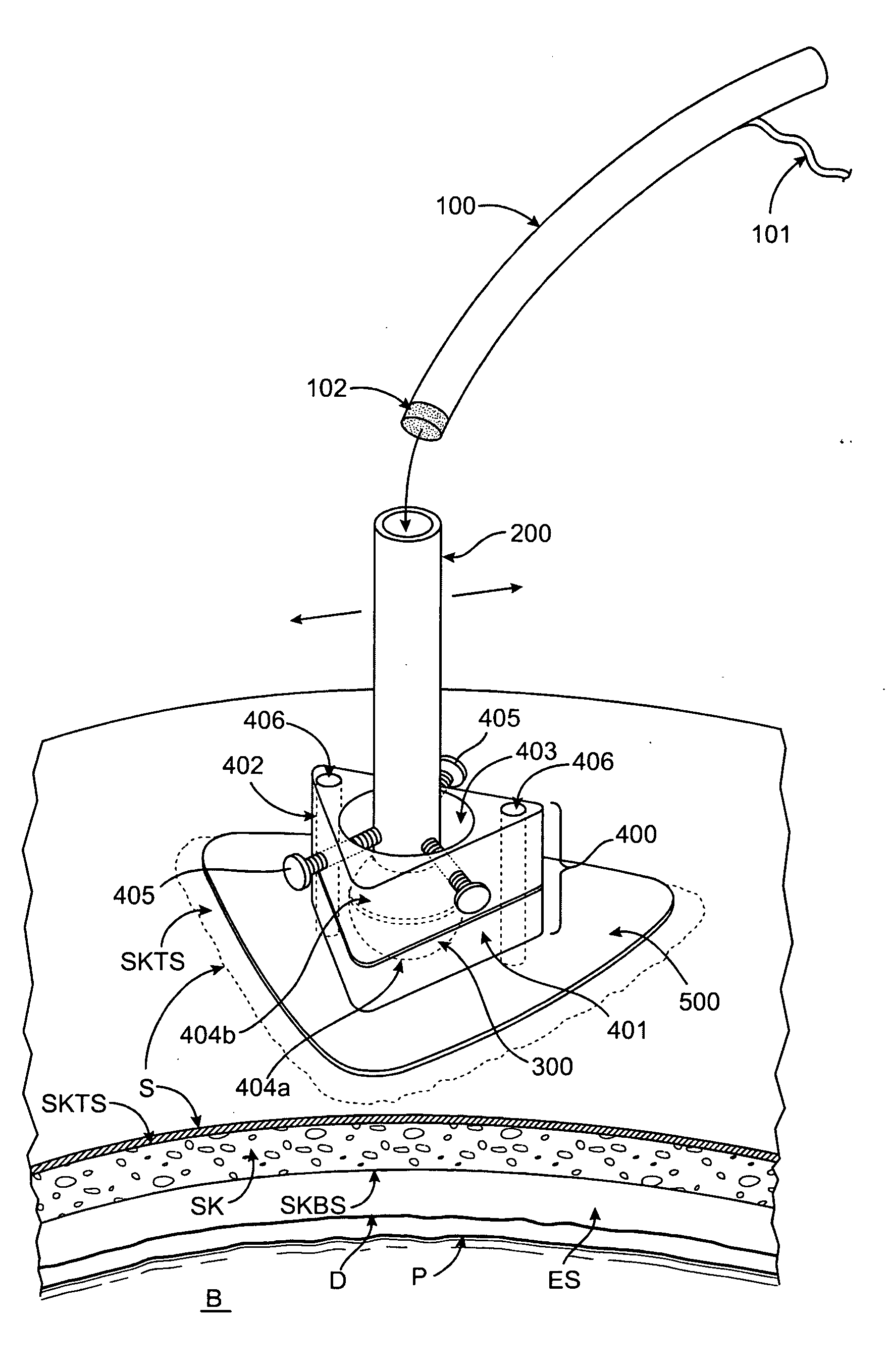 Methods and apparatus for intracranial ultrasound therapies