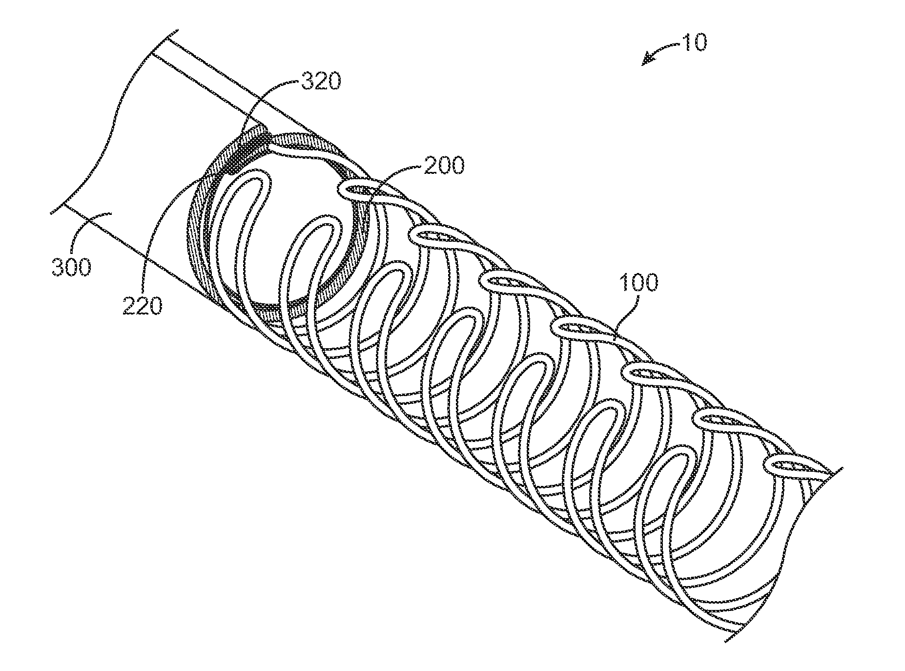 Elastic Introducer Sheath