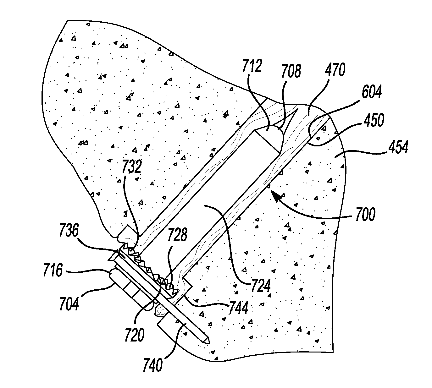 Method And Apparatus For Tibial Fixation Of An ACL Graft
