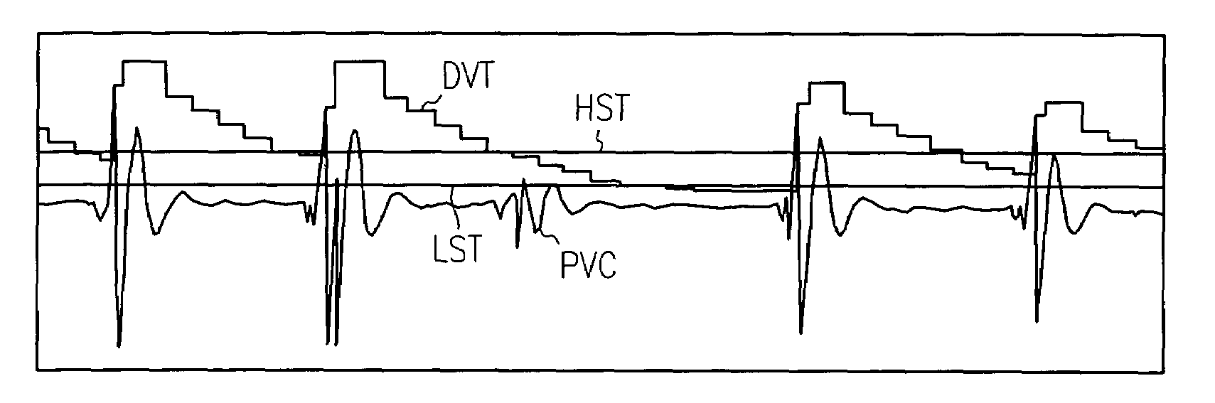 Apparatus and method for R-wave detection with dual dynamic sensitivities