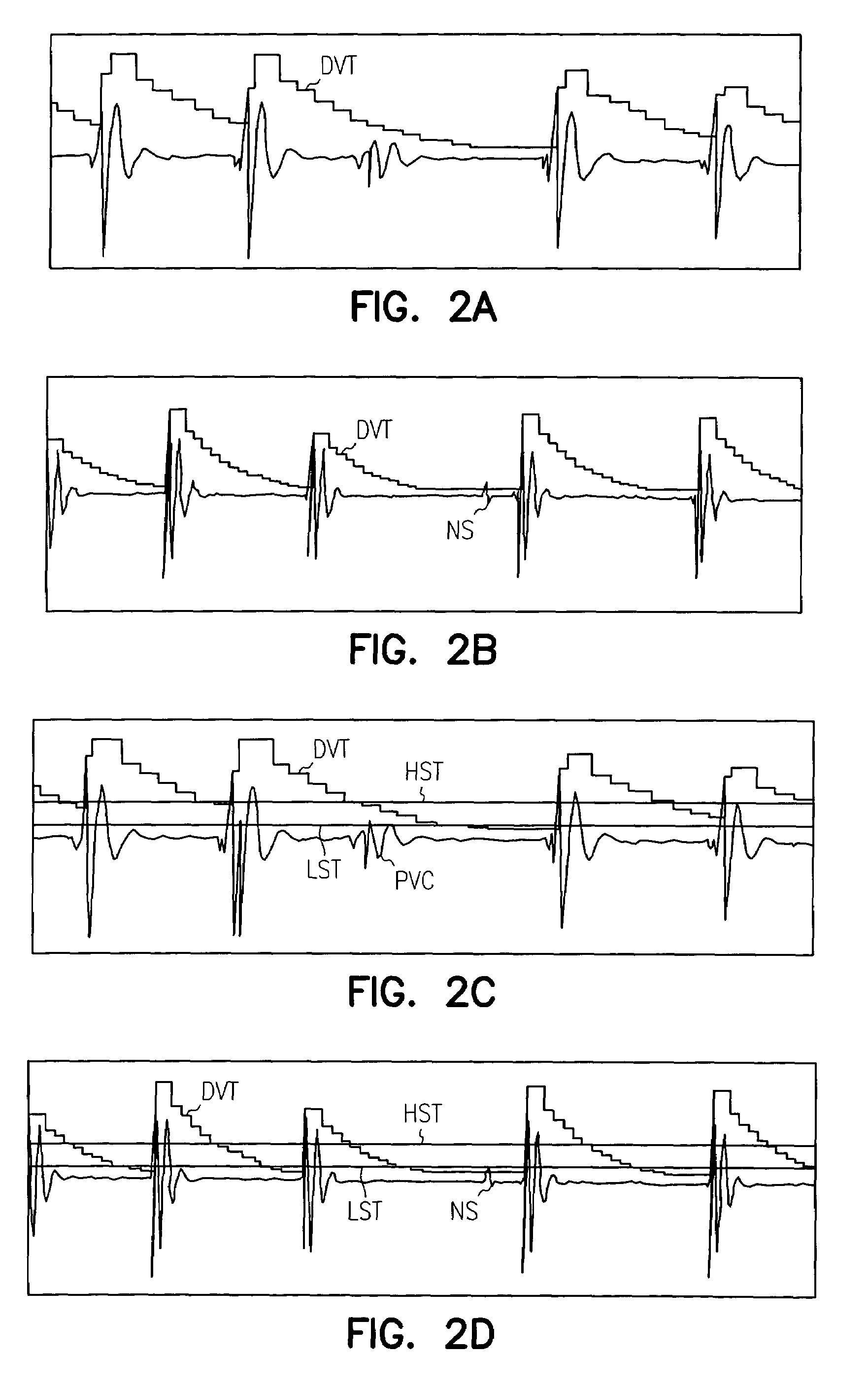 Apparatus and method for R-wave detection with dual dynamic sensitivities