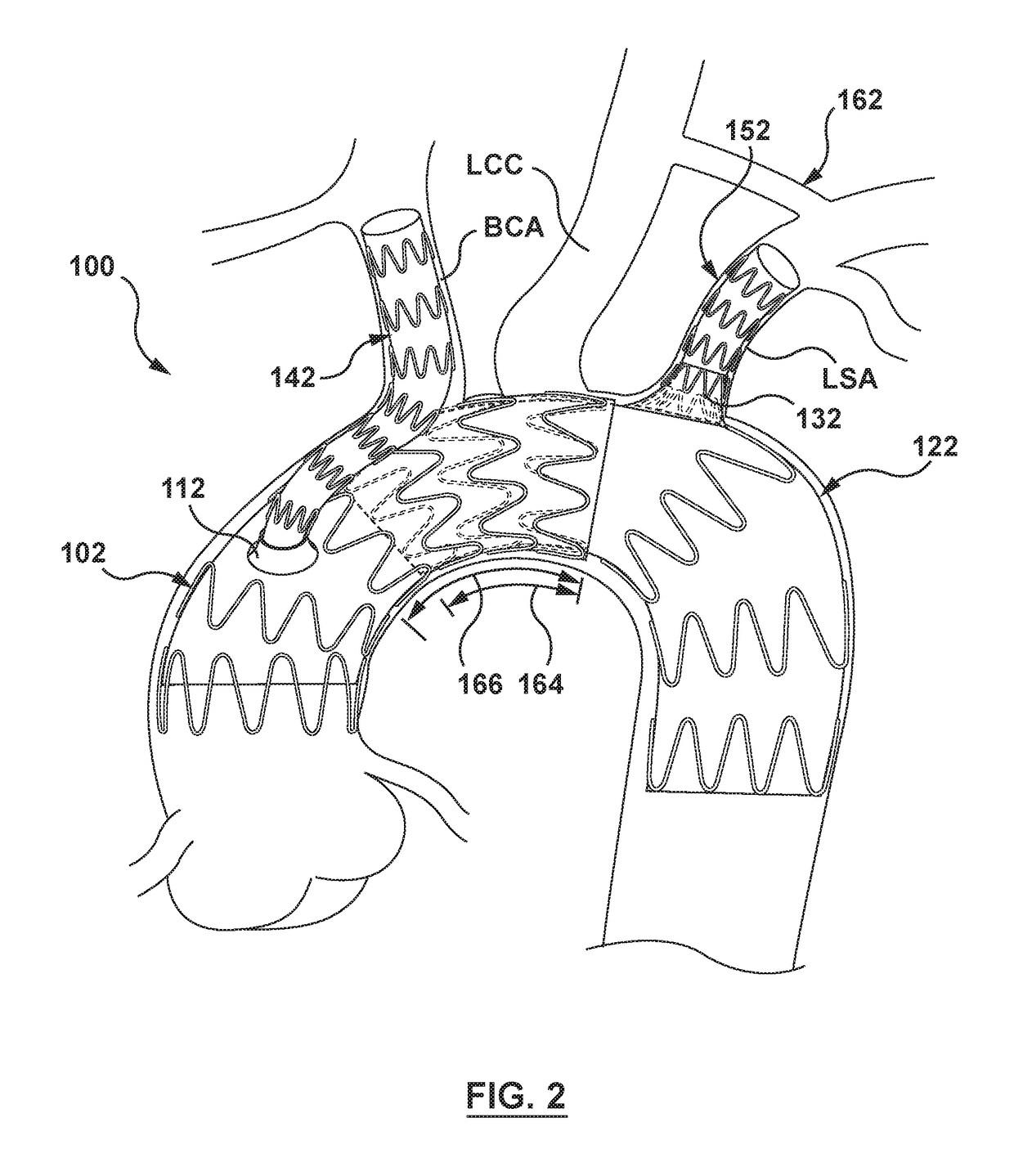 Modular aortic arch prosthetic assembly and method of use thereof
