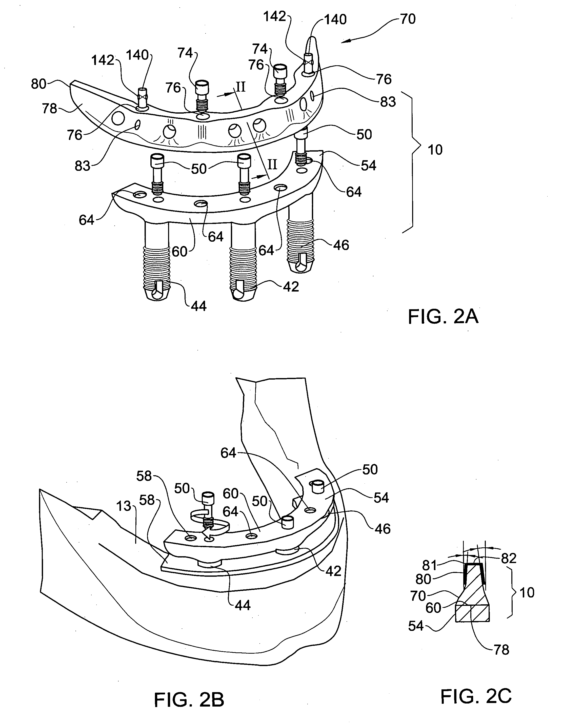 Method and system for fixing removable dentures