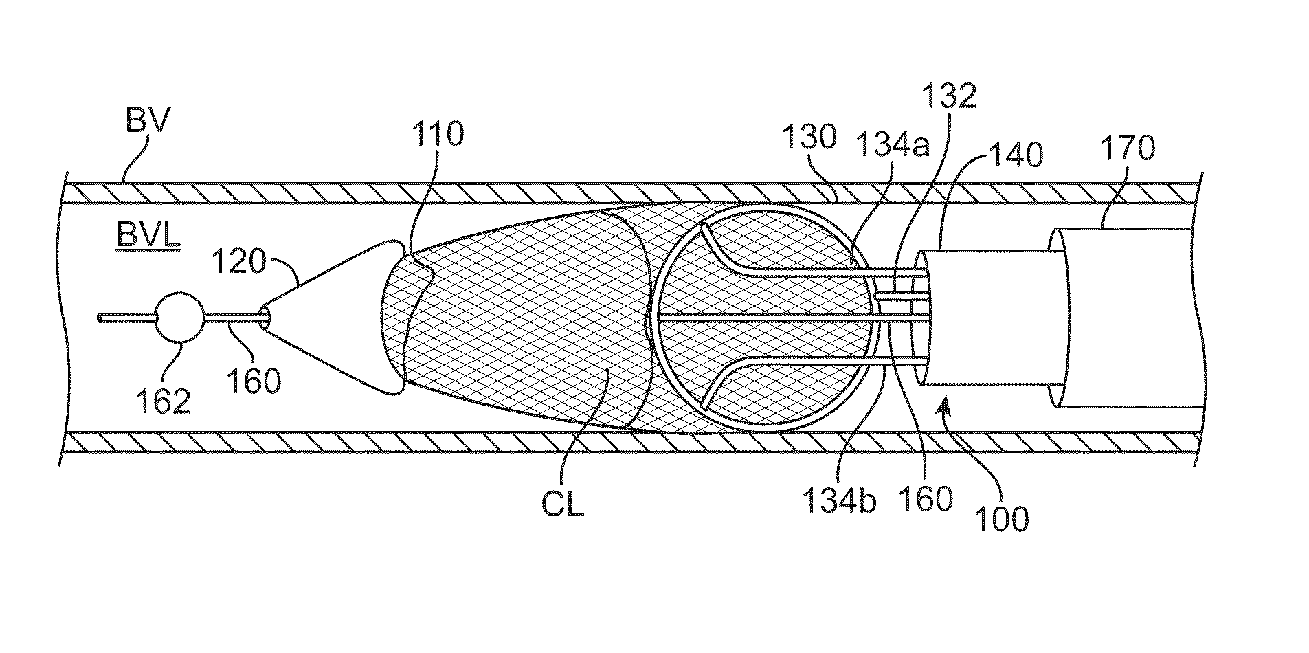 Thrombus removal and intravascular distal embolic protection device