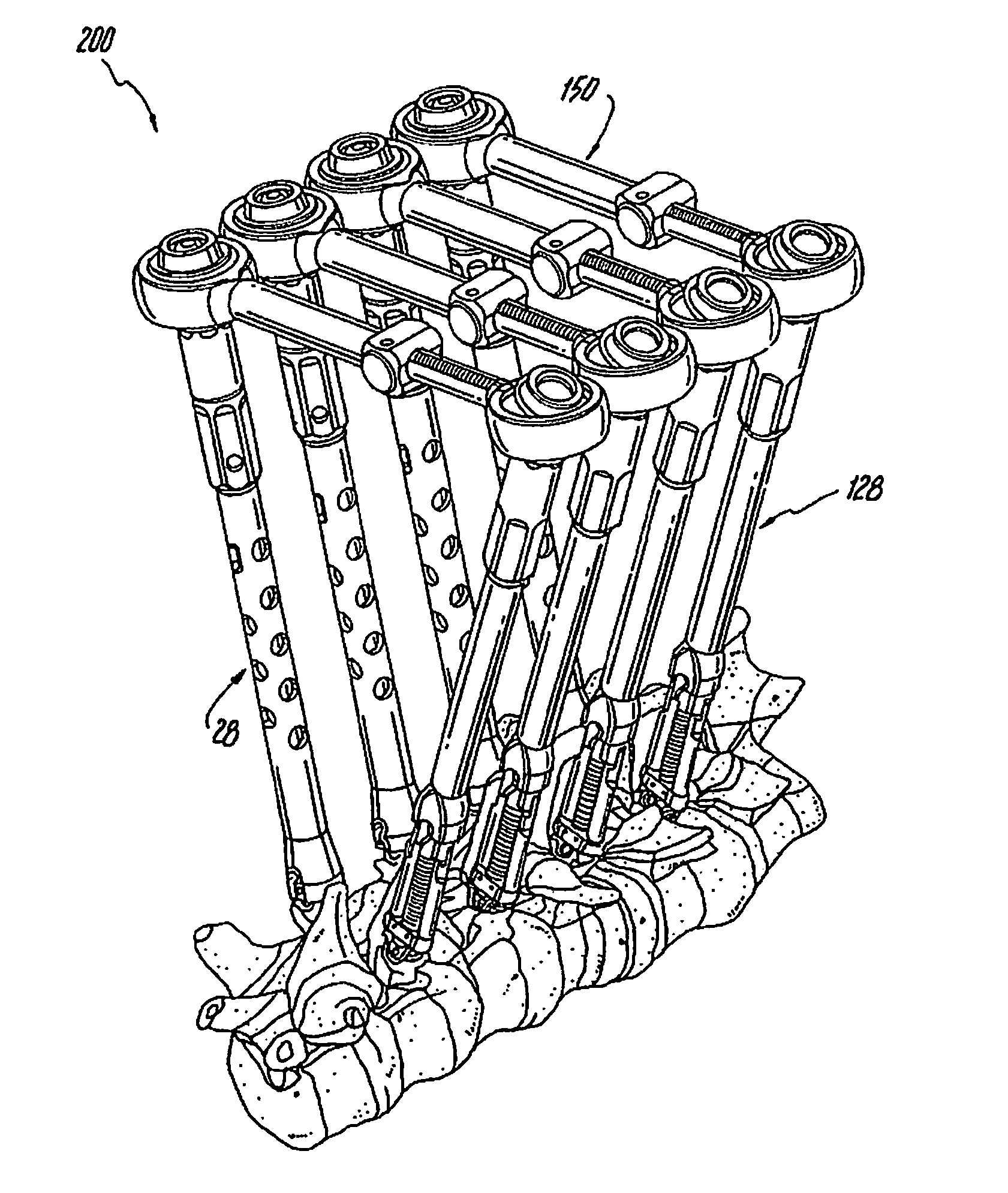 System and method for performing spinal surgery