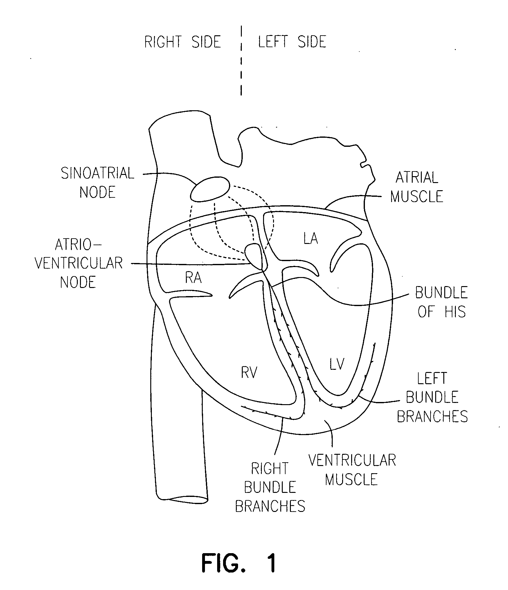 Cardiac pacing using adjustable atrio-ventricular delays