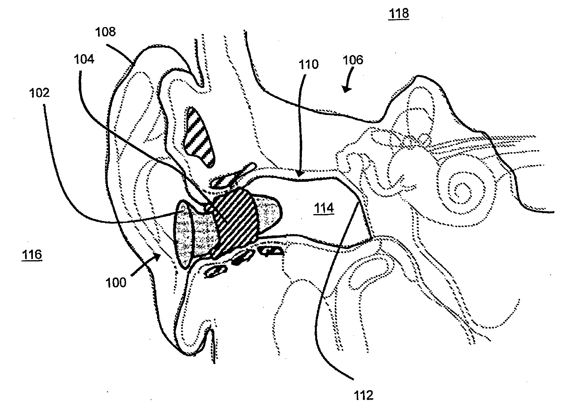 Methods and devices for radio frequency (RF) mitigation proximate the ear