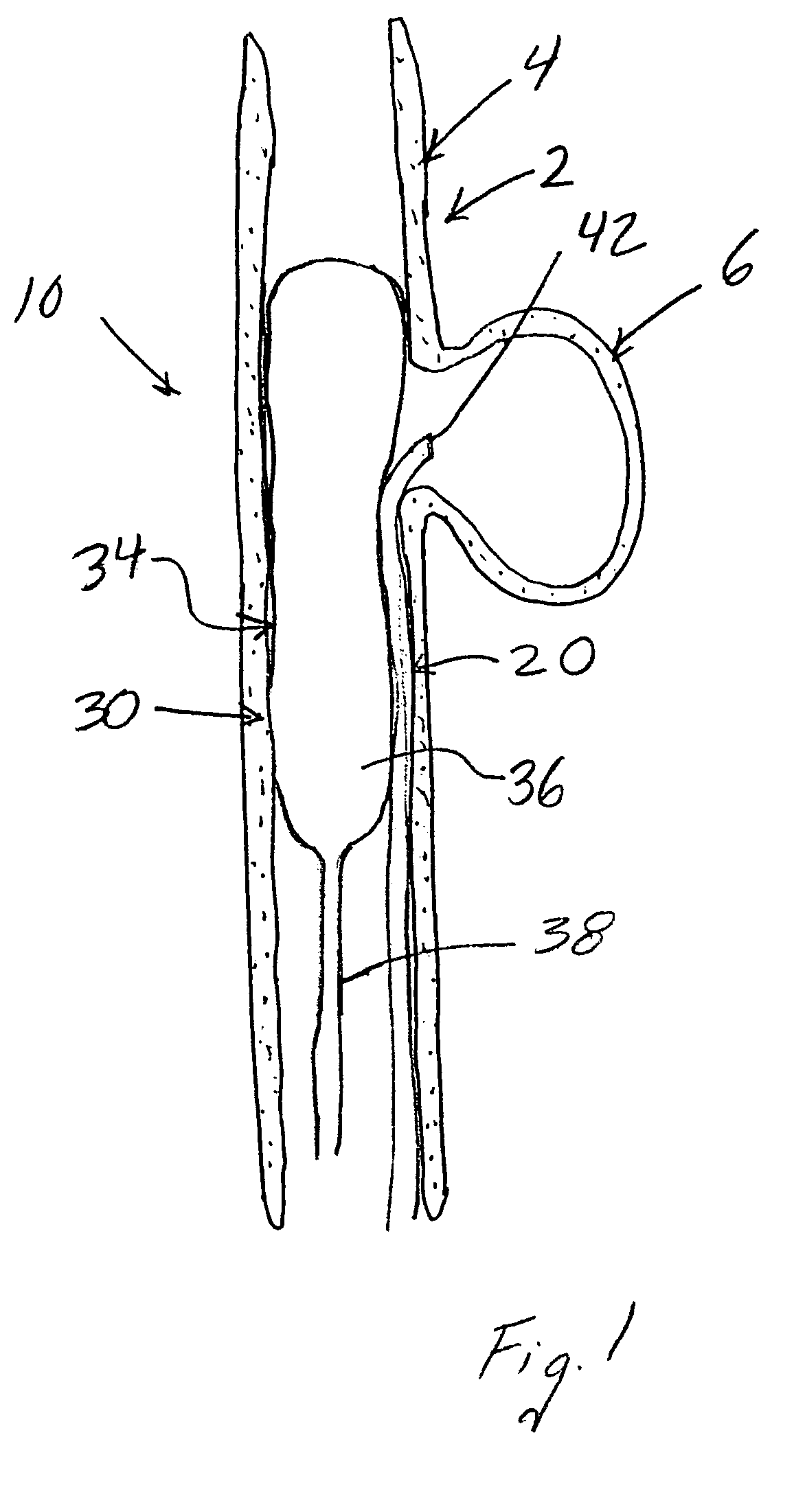 Compositions, systems and methods for treatment of defects in blood vessels