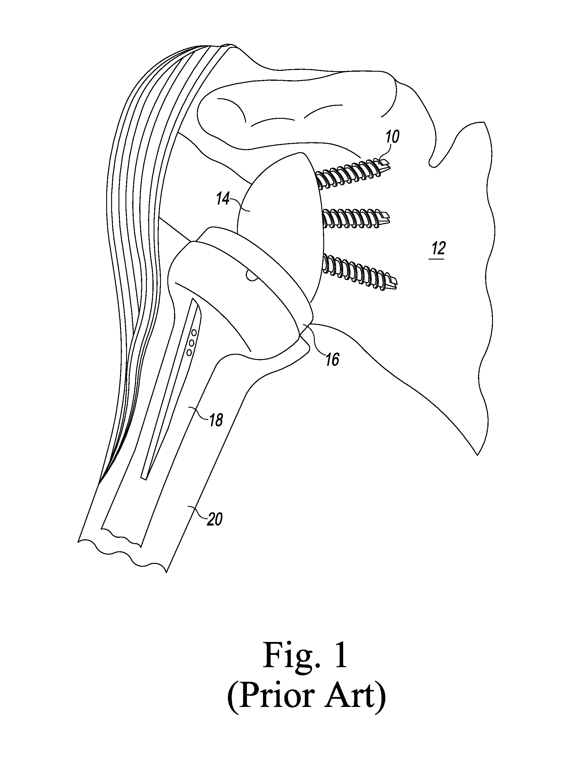 Bone graft shaper for reverse glenoid