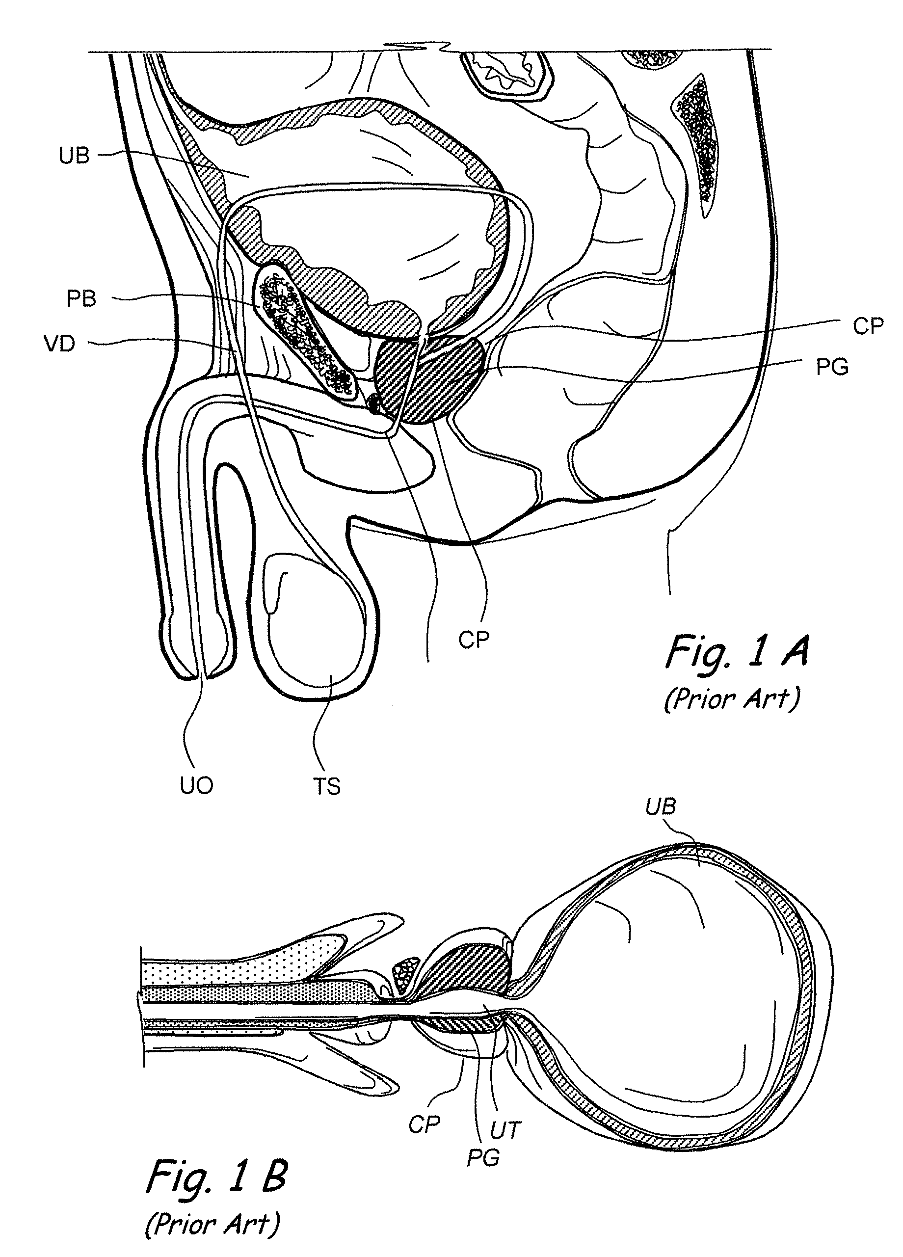 Devices, systems and methods for treating benign prostatic hyperplasia and other conditions