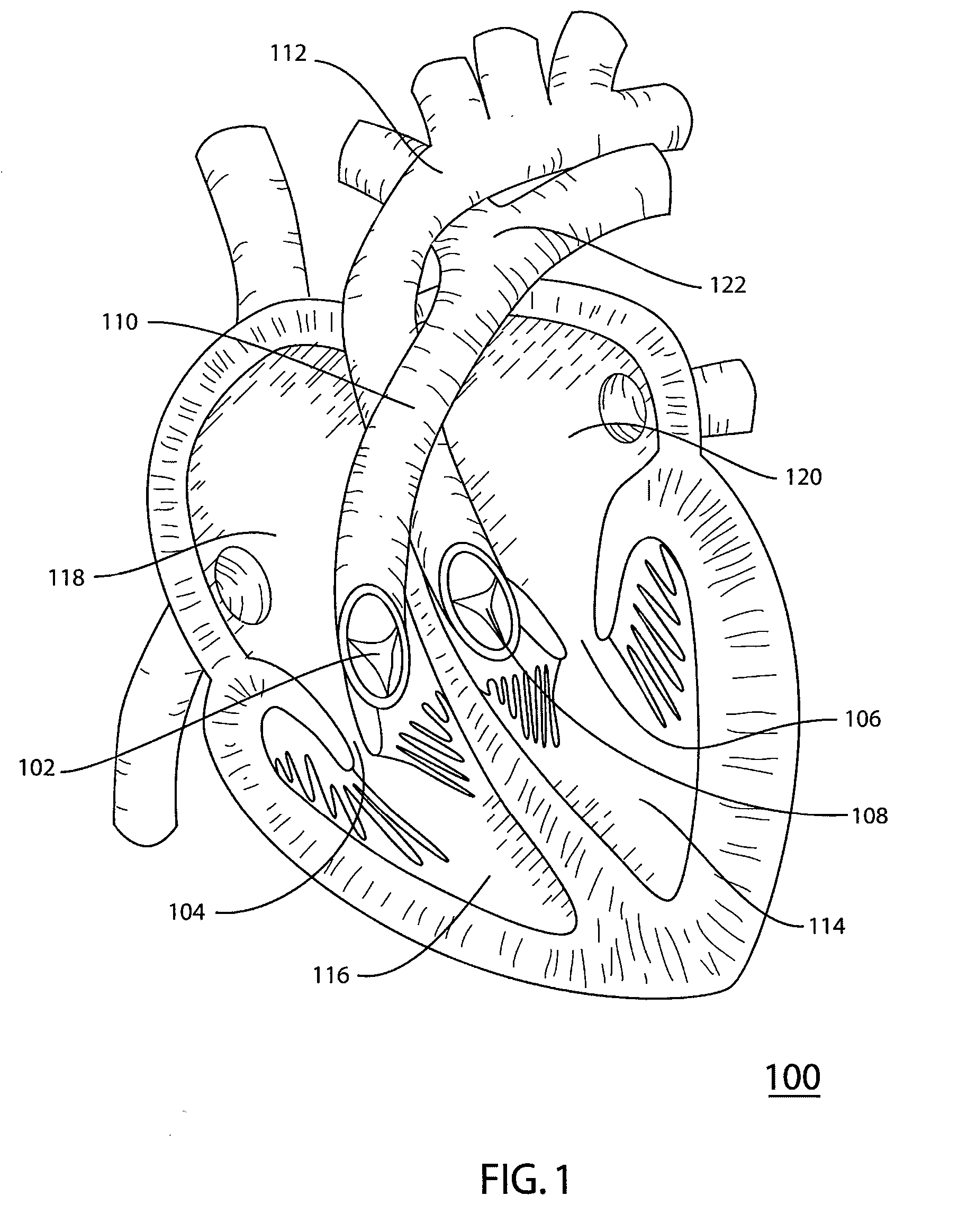 Catheter Delivered Valve Having a Barrier to Provide an Enhanced Seal