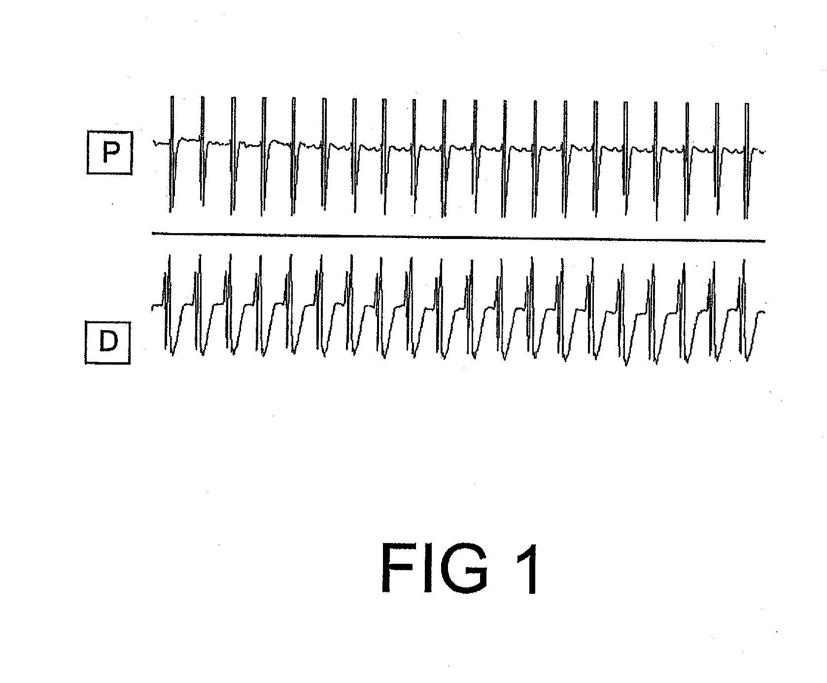 Pharmaceutical composition comprising plant material or trichilia sp. alone or in association with other plant extracts for the reversion/combat and/or prevention of ventricular fibrillation