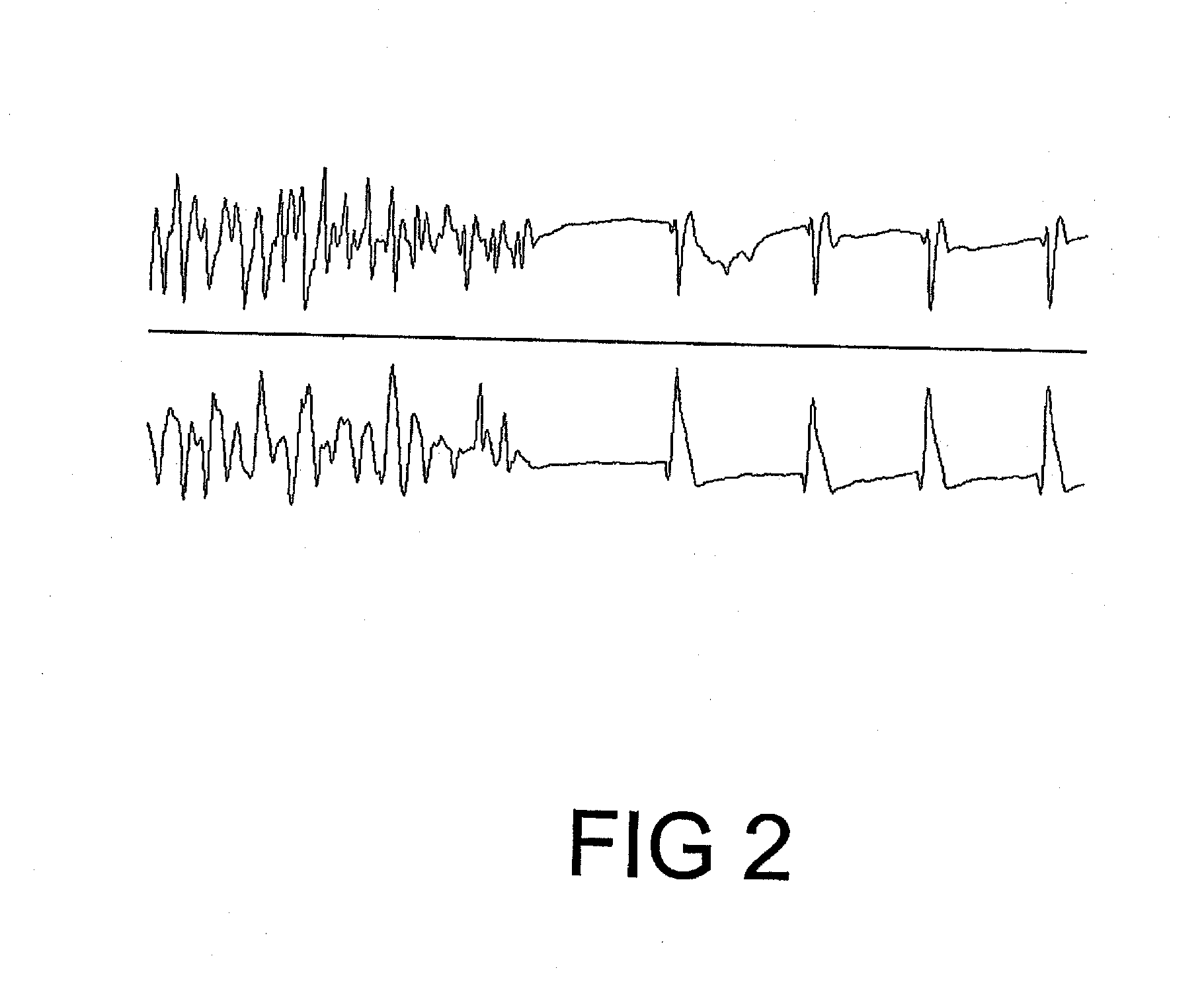 Pharmaceutical composition comprising plant material or trichilia sp. alone or in association with other plant extracts for the reversion/combat and/or prevention of ventricular fibrillation