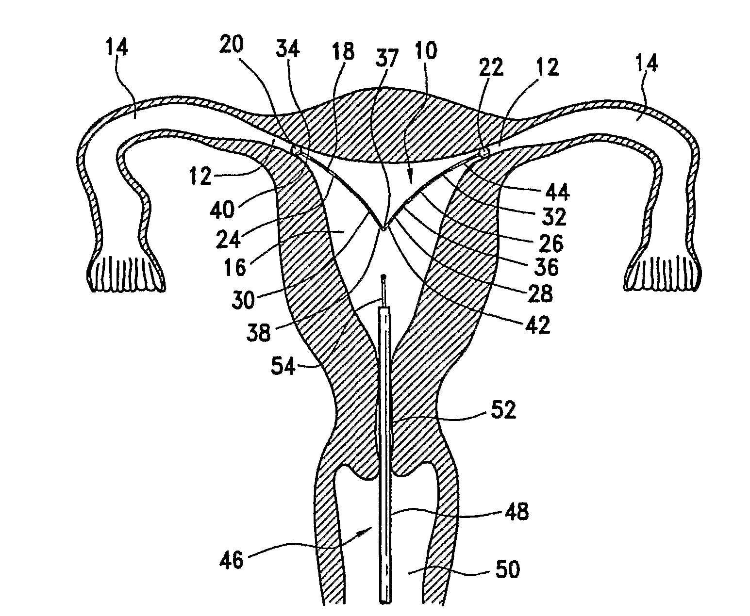 Intrauterine Fallopian Tube Occlusion Device and Method For Use