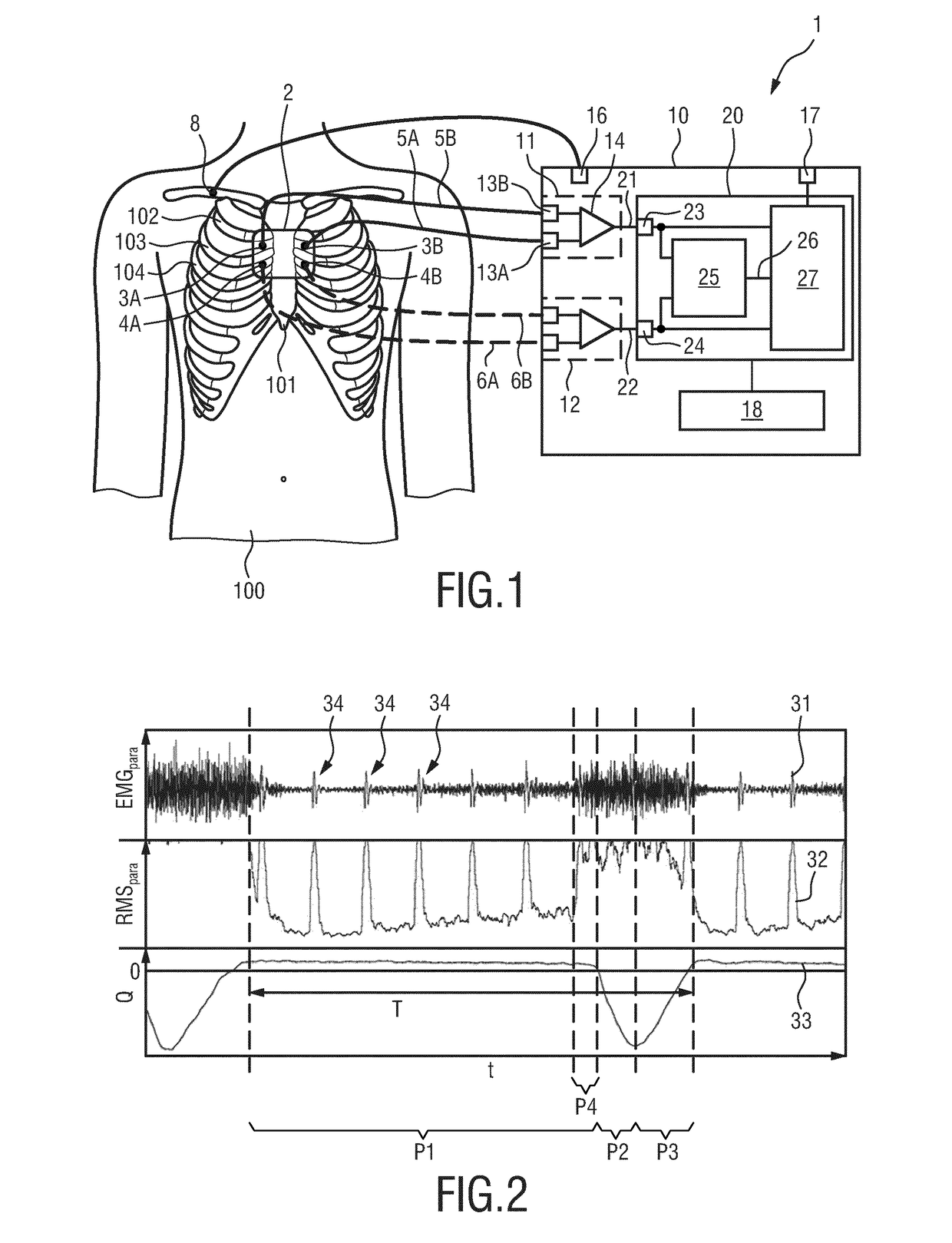 Apparatus and method for processing electromyography signals related to respiratory activity