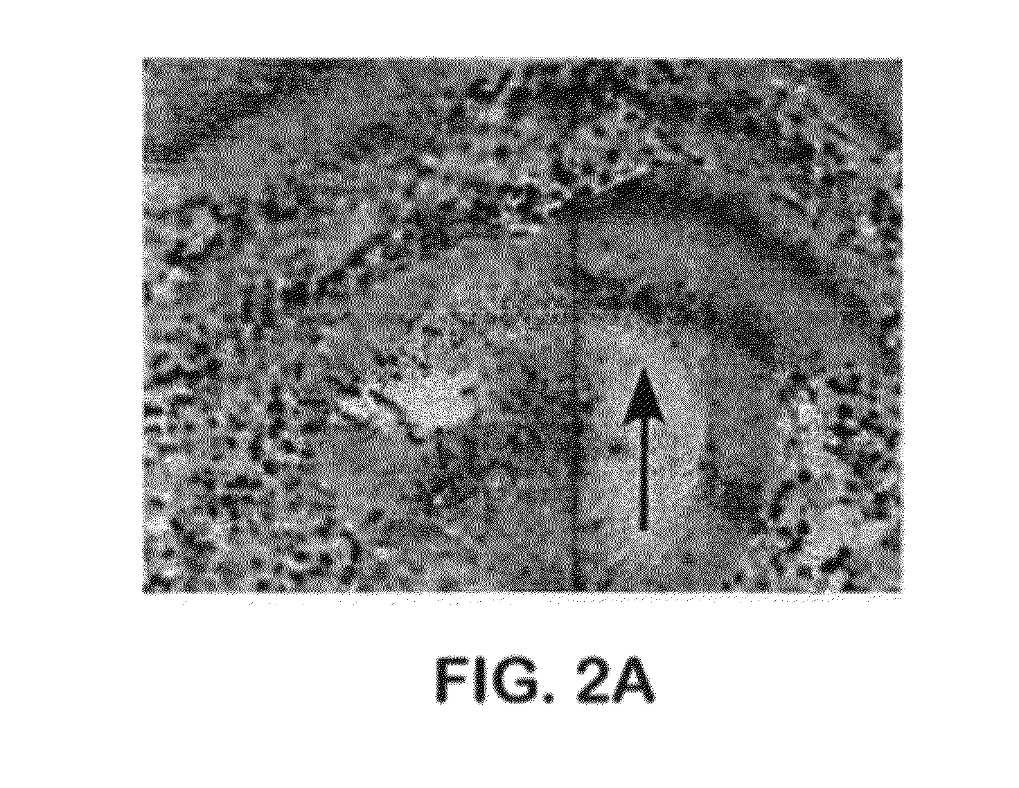 Methods for diagnosis and treatment of endometrial cancer