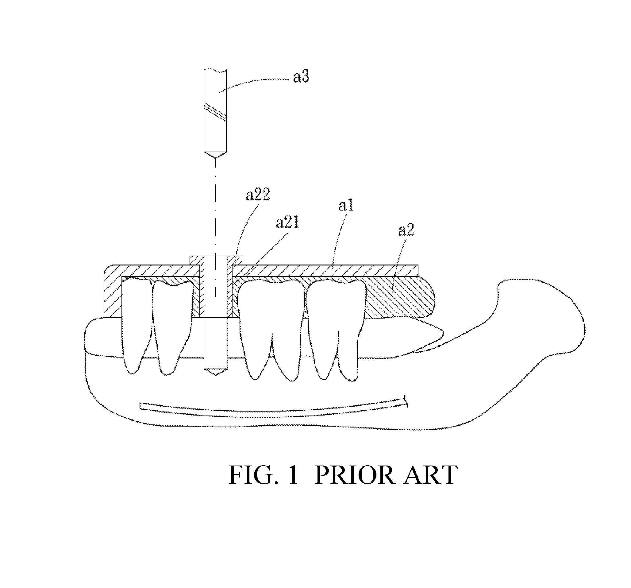 Dental positioning stent, and manufacturing method, using method and components for the same