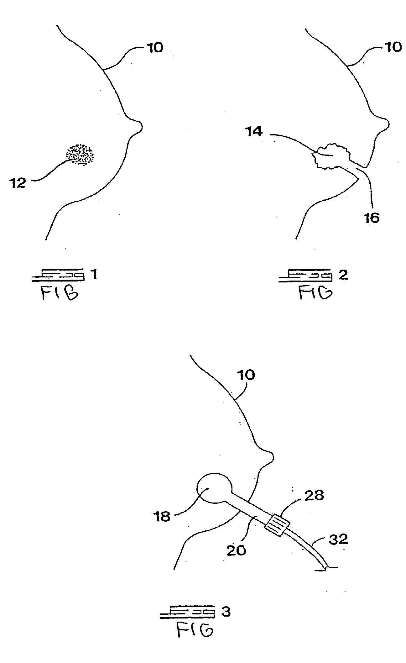 Devices and methods to conform and treat body cavities