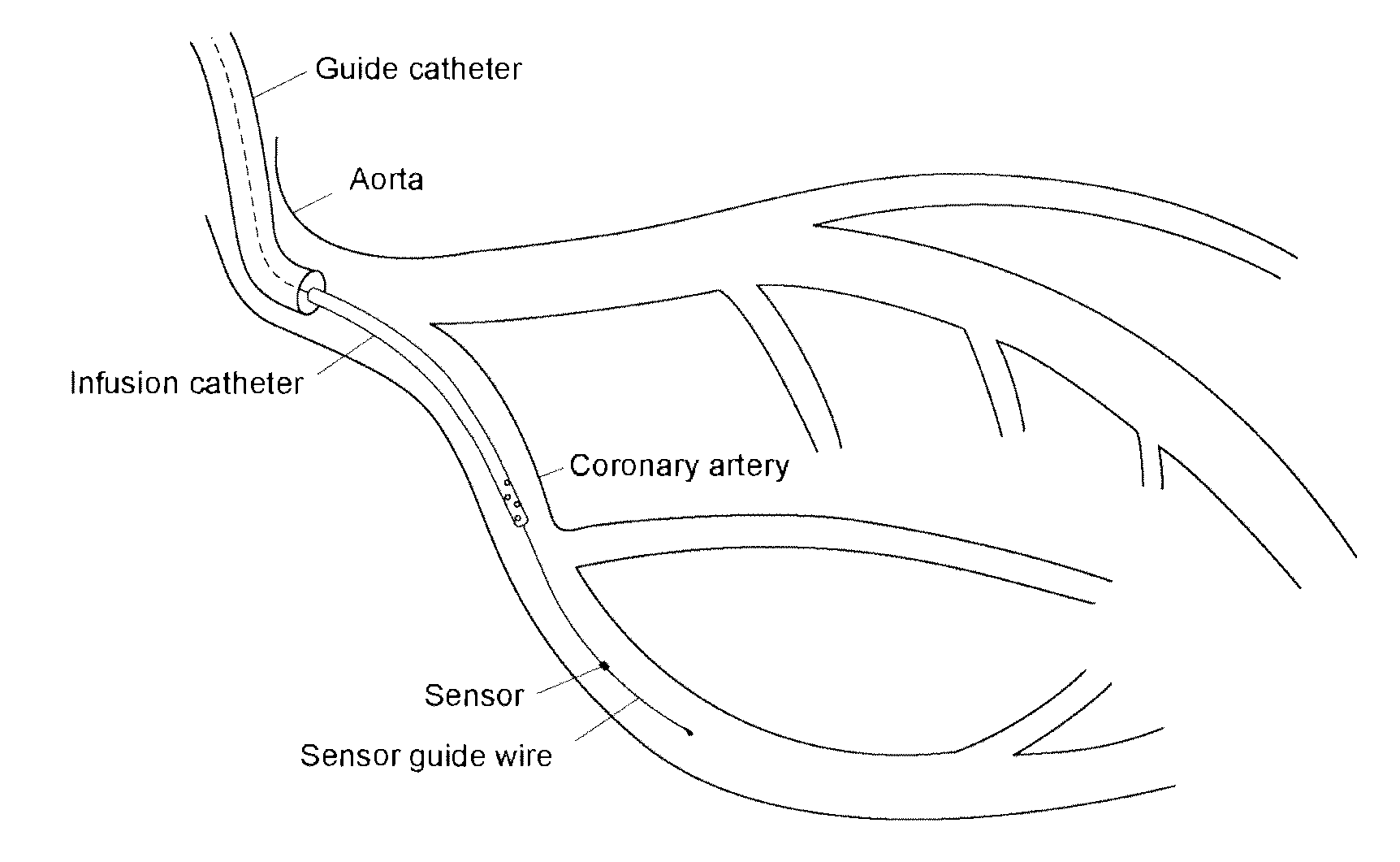 System for determining the blood flow in a coronary artery