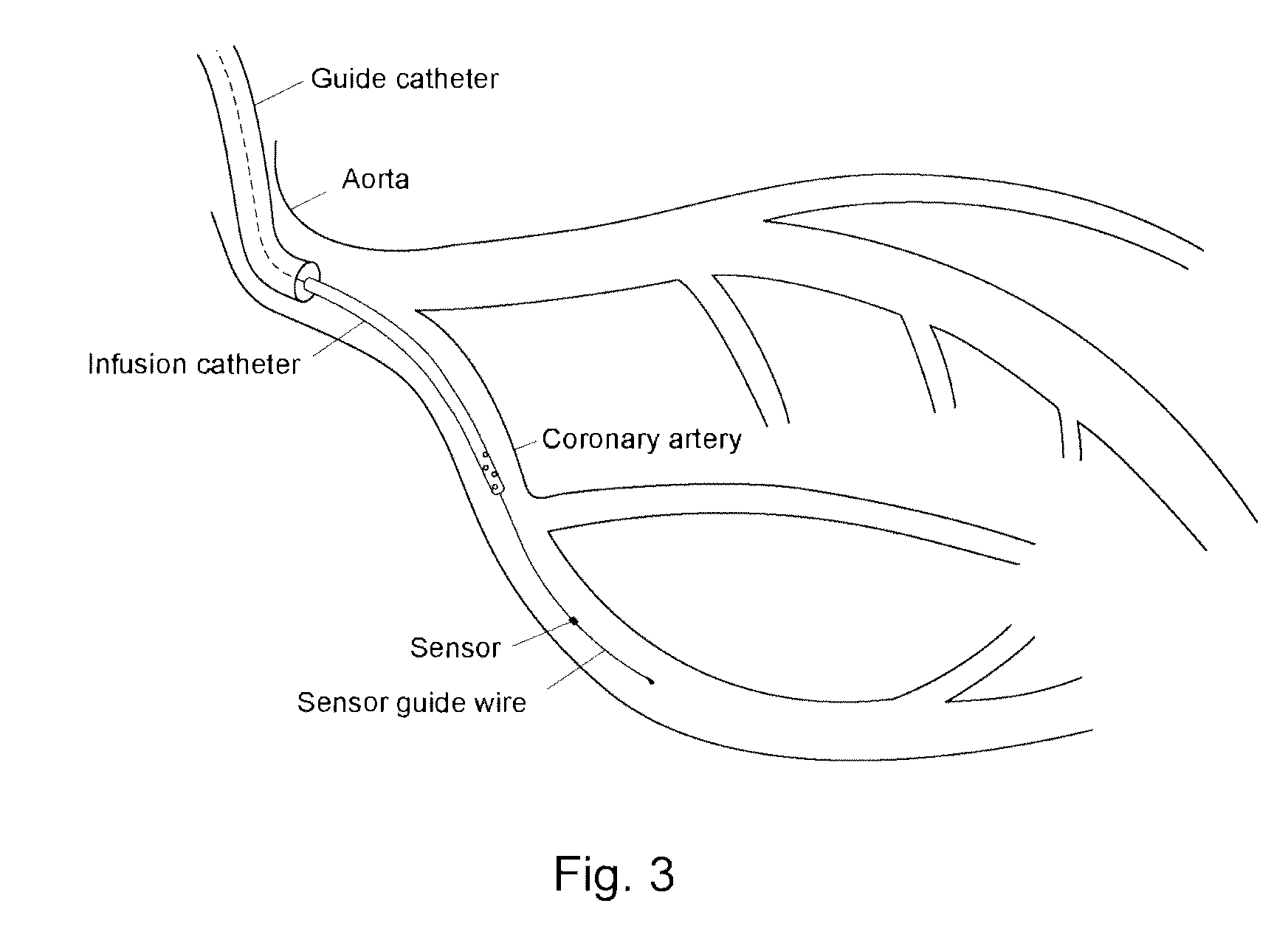 System for determining the blood flow in a coronary artery